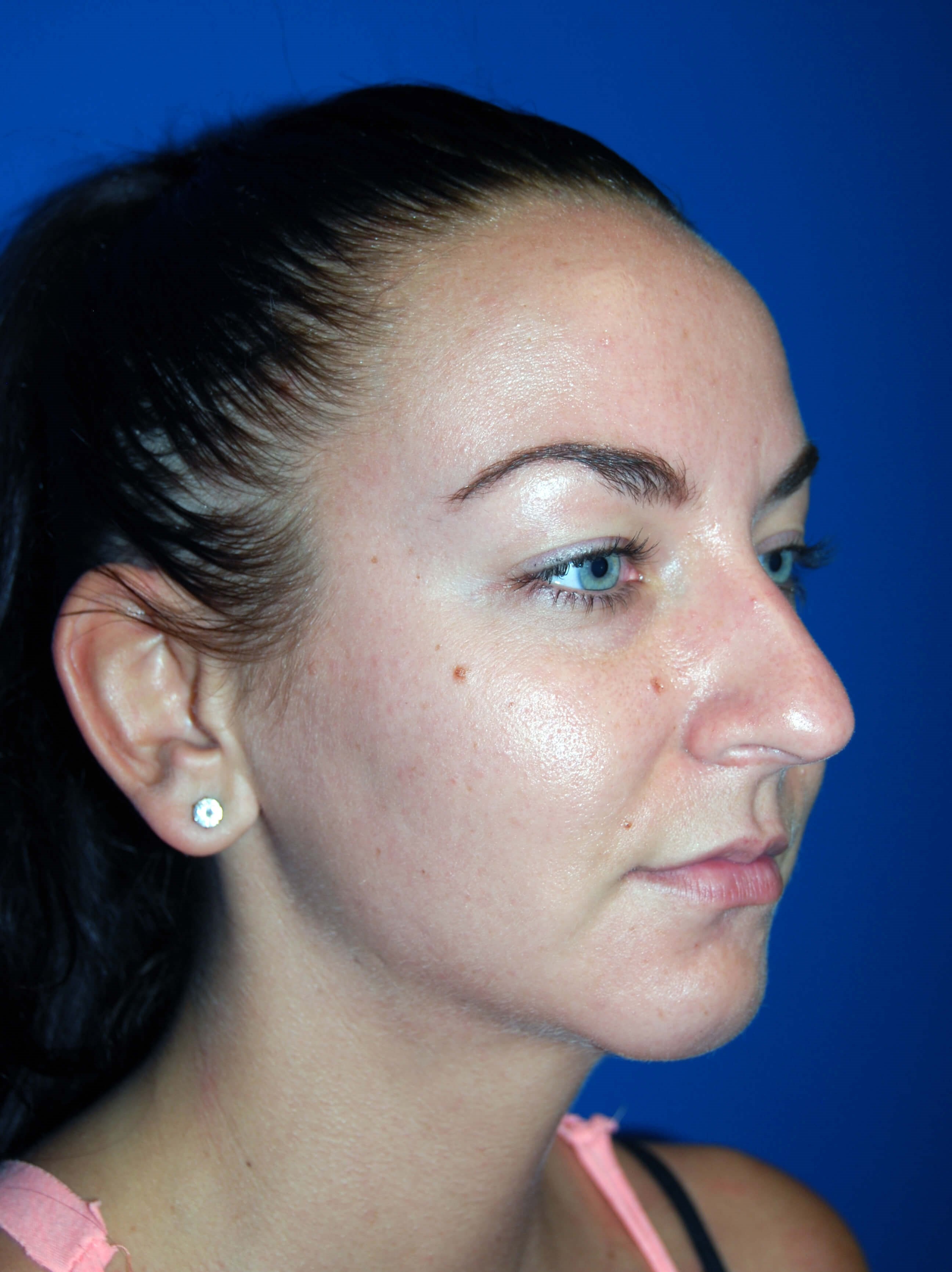 Oblique - Right After