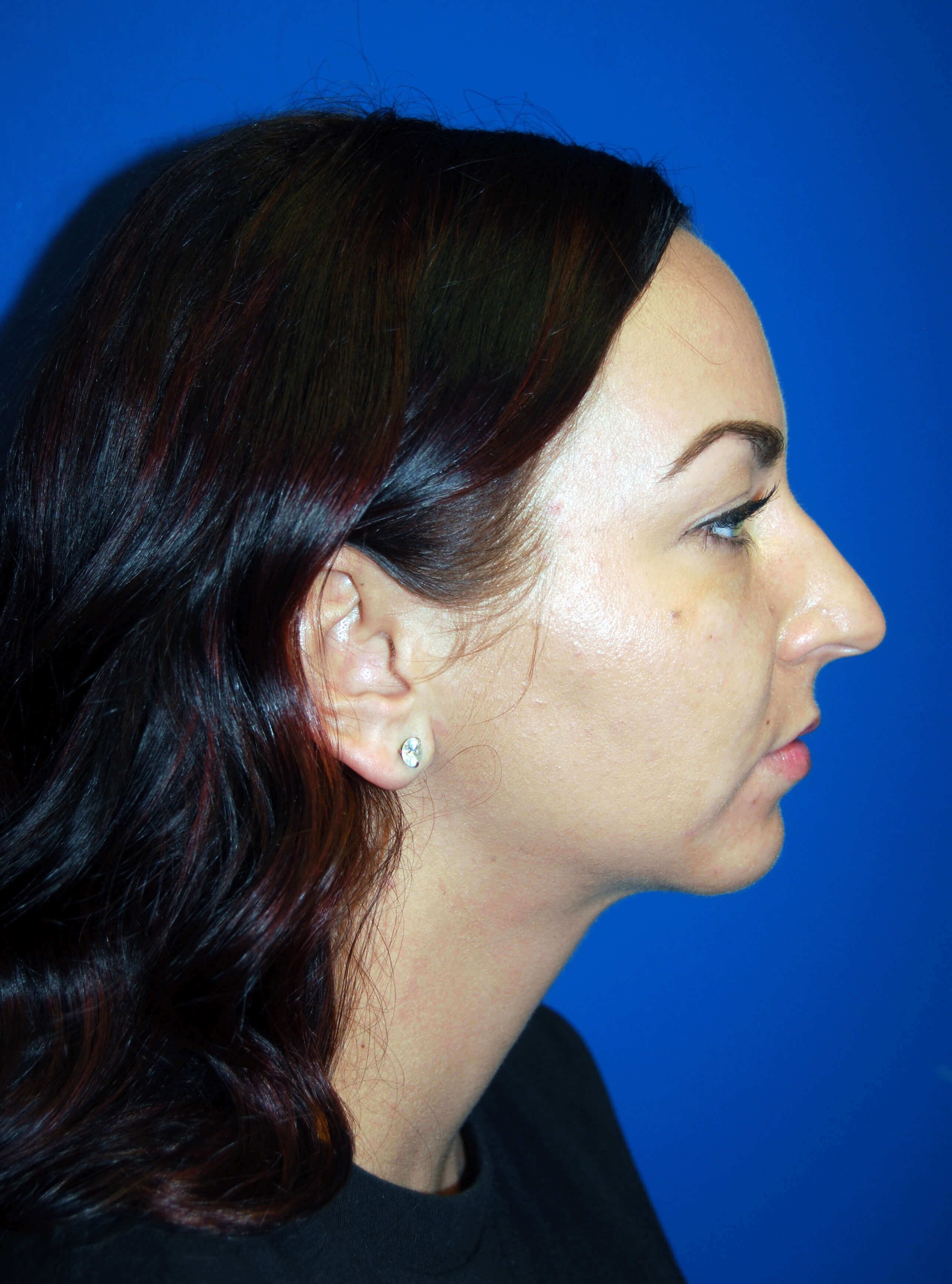 Lateral - Right After