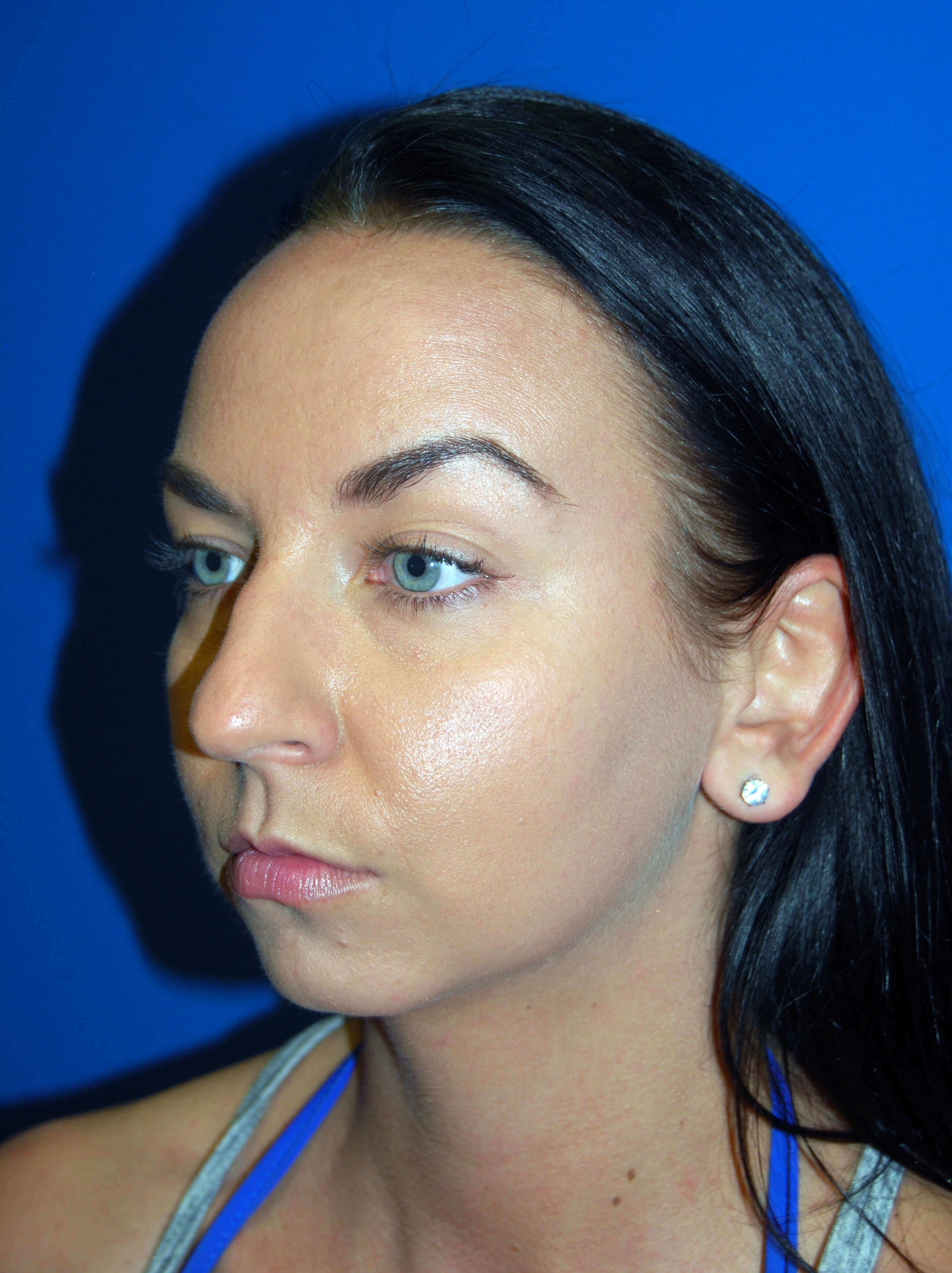 Oblique - Left Before