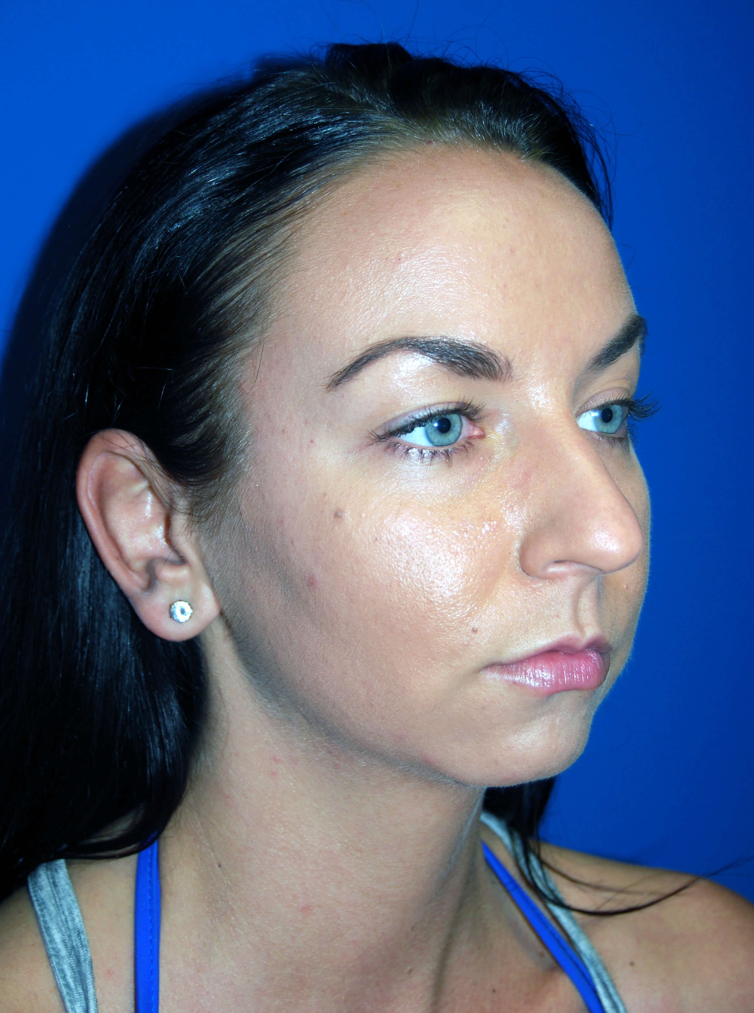Oblique - Right Before