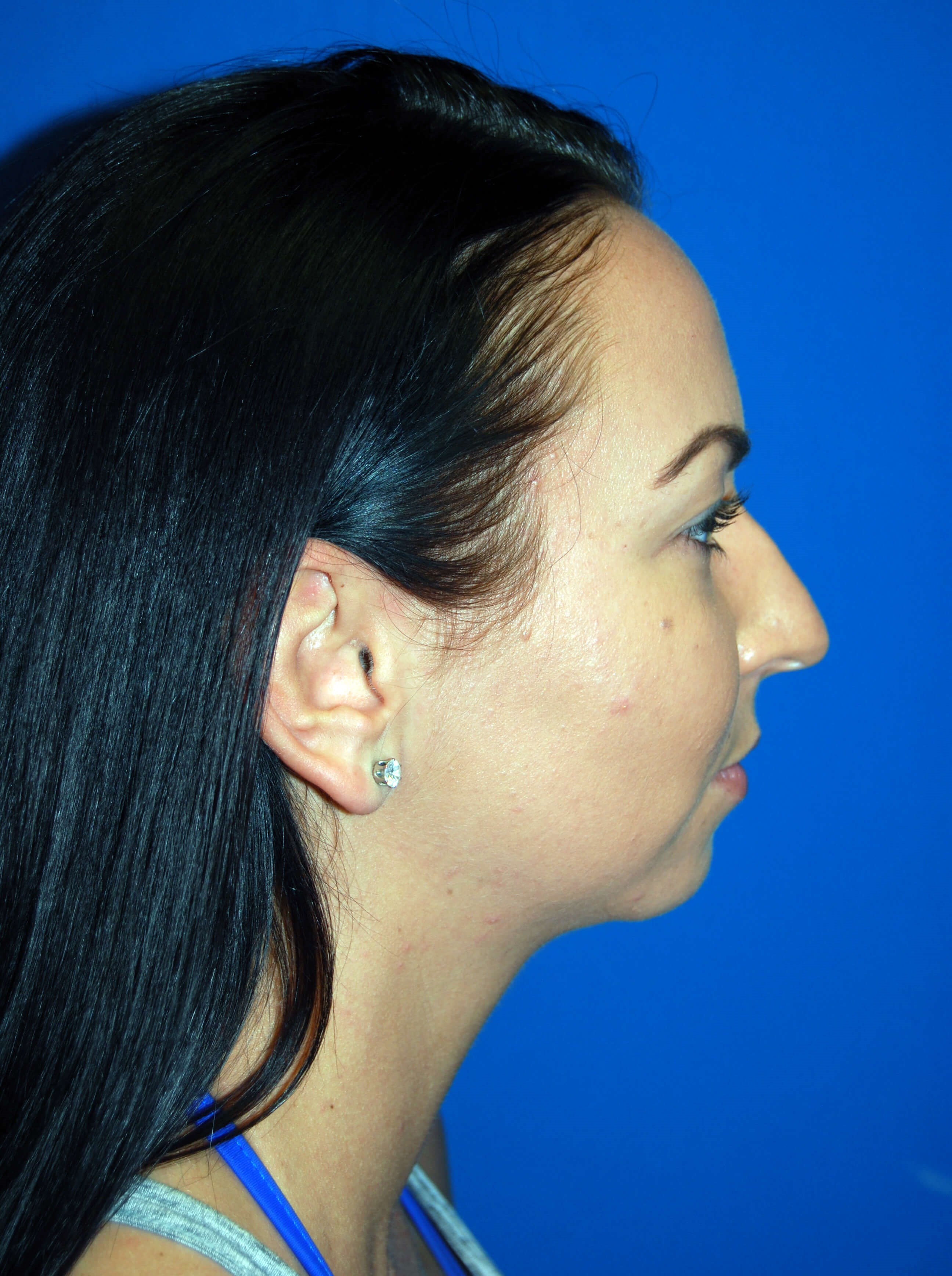Lateral - Right Before