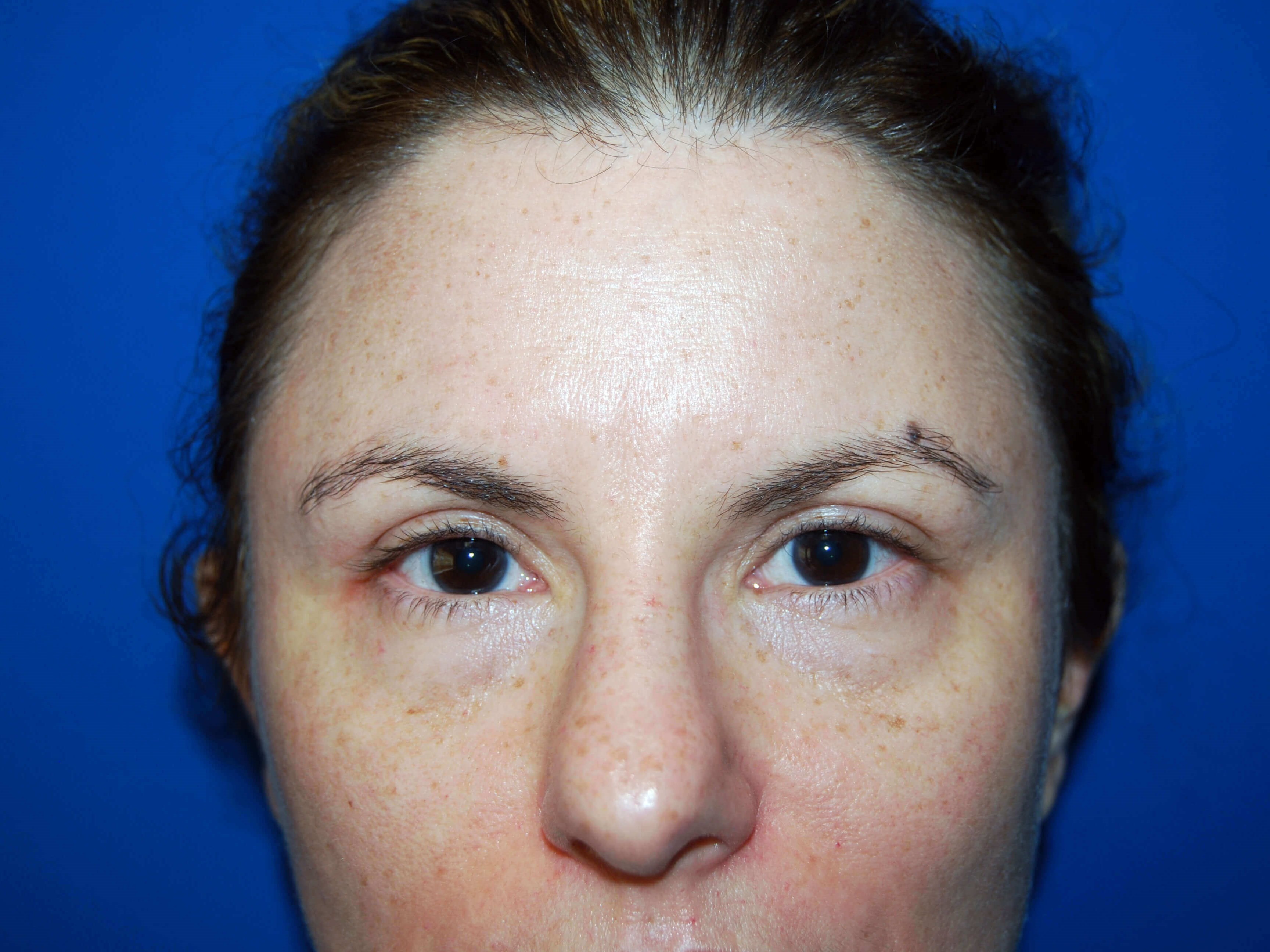Front View After Upper Eyelid Lift