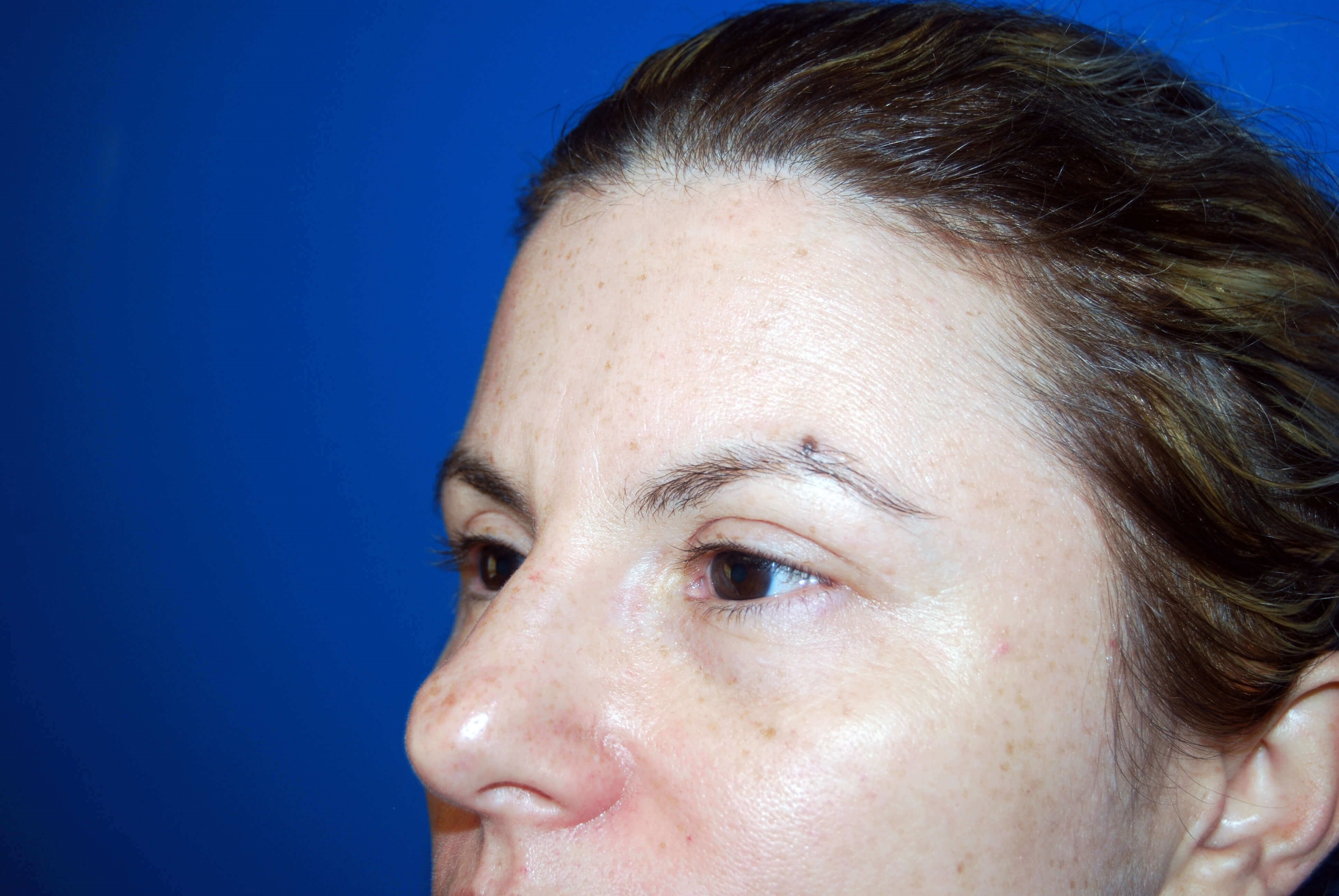 Left Side View After Upper Eyelid Lift
