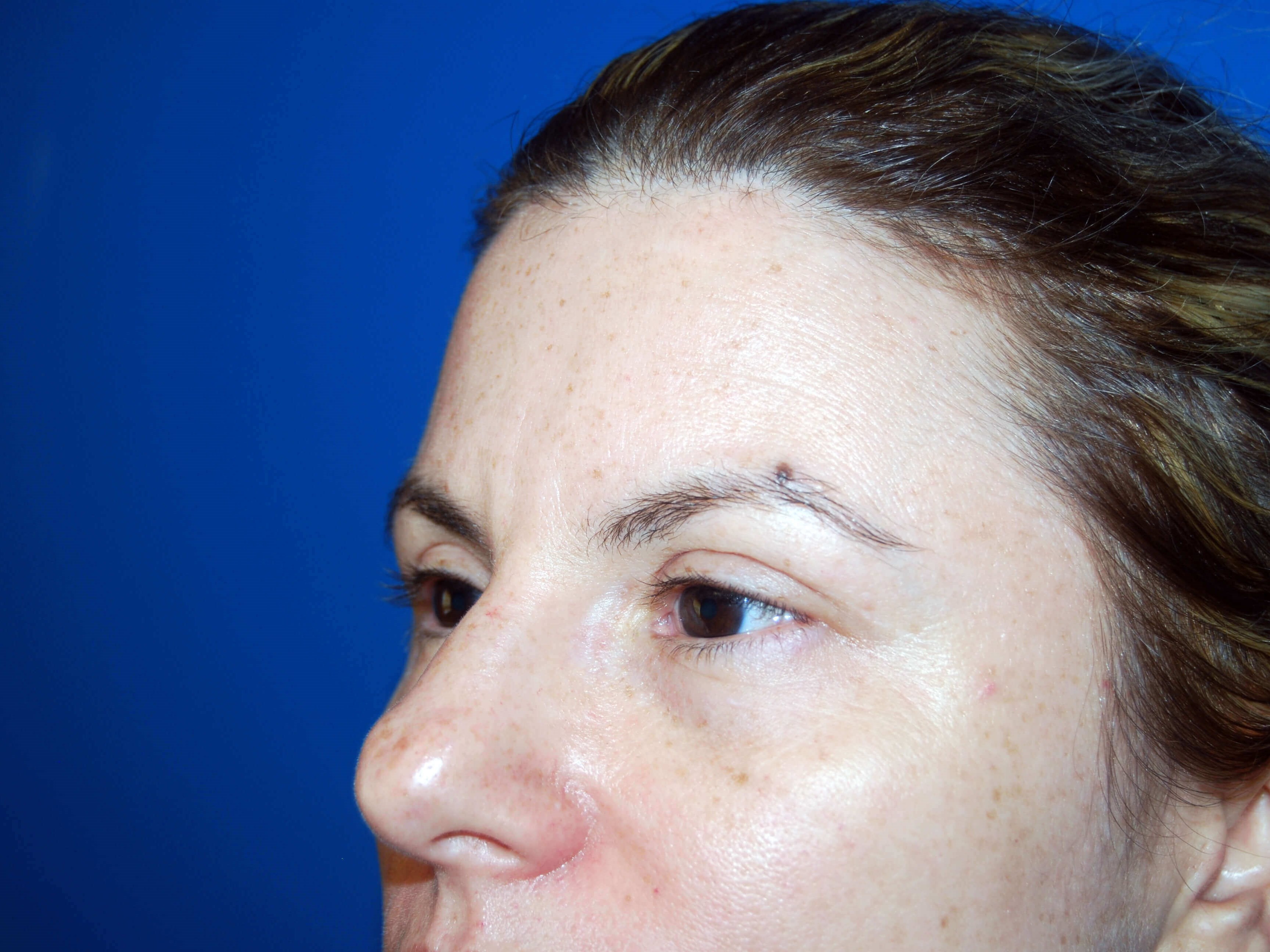 Left Side View After Upper Eyelid Lift