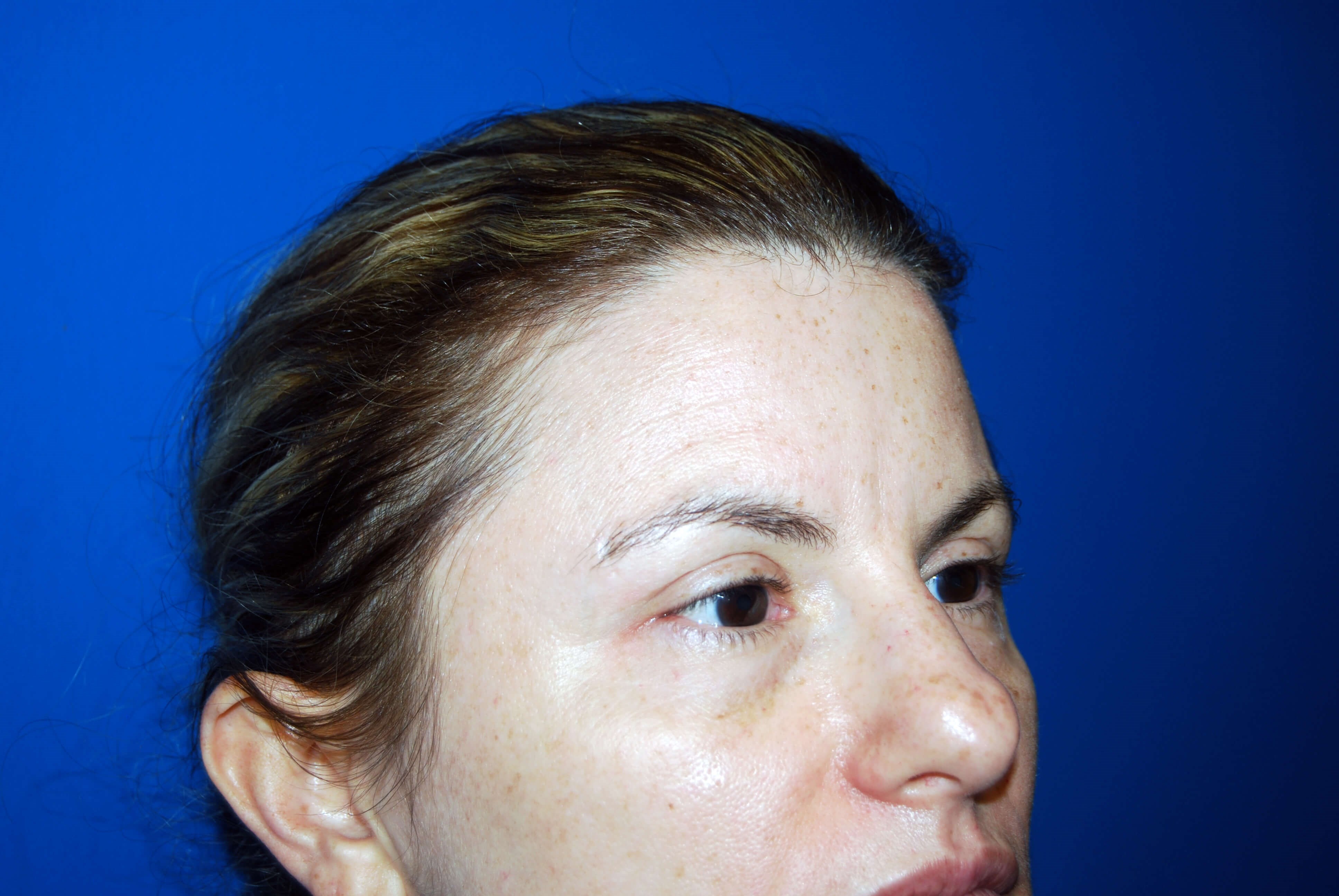 Right Side View After Upper Eyelid Lift