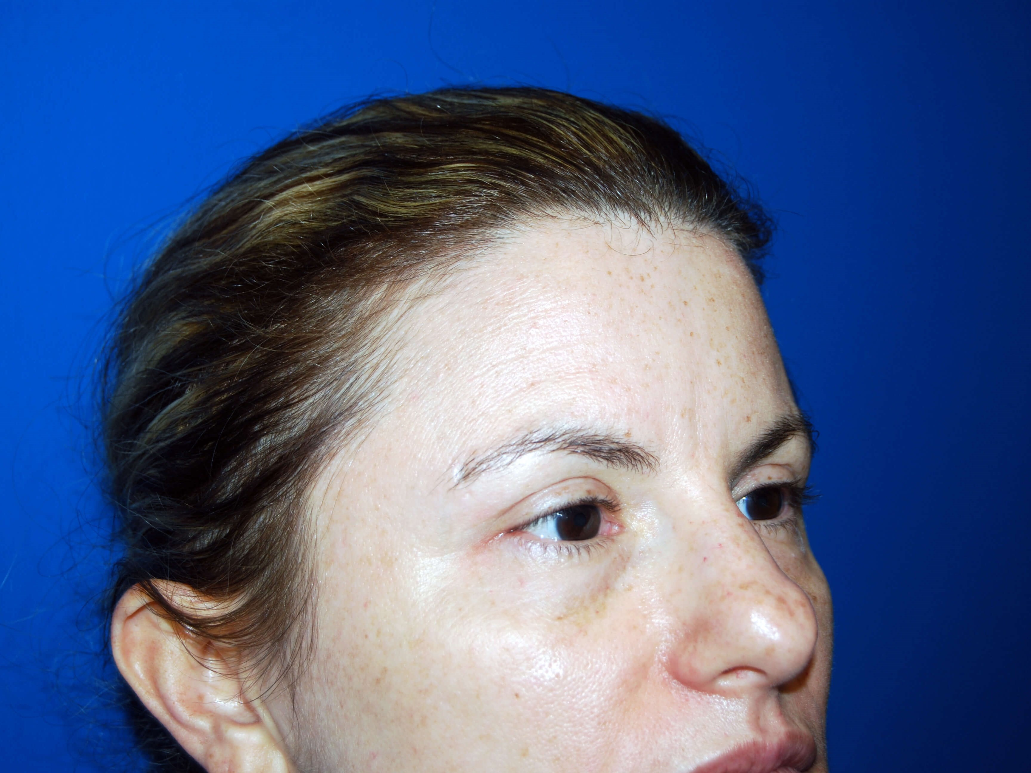Right Side View After Upper Eyelid Lift