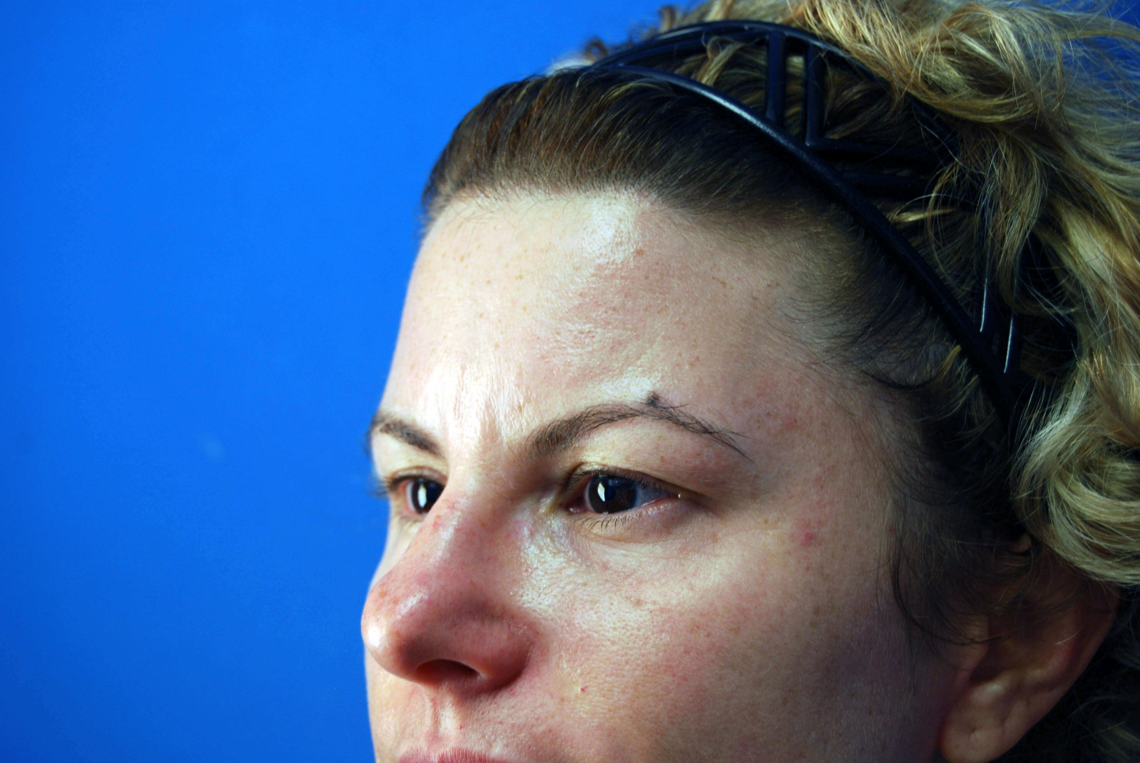 Left Side View Before Upper Eyelid Lift