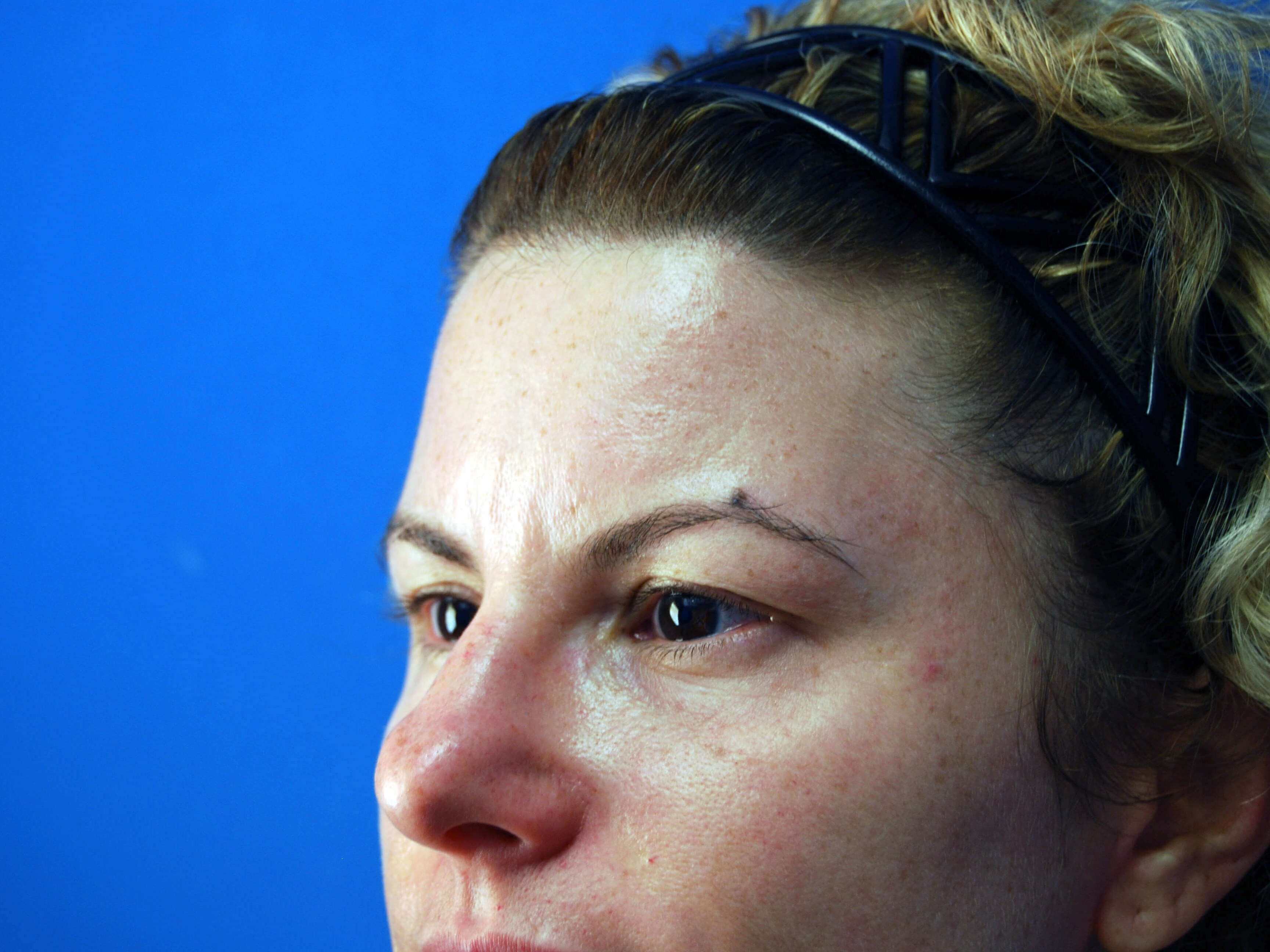 Left Side View Before Upper Eyelid Lift
