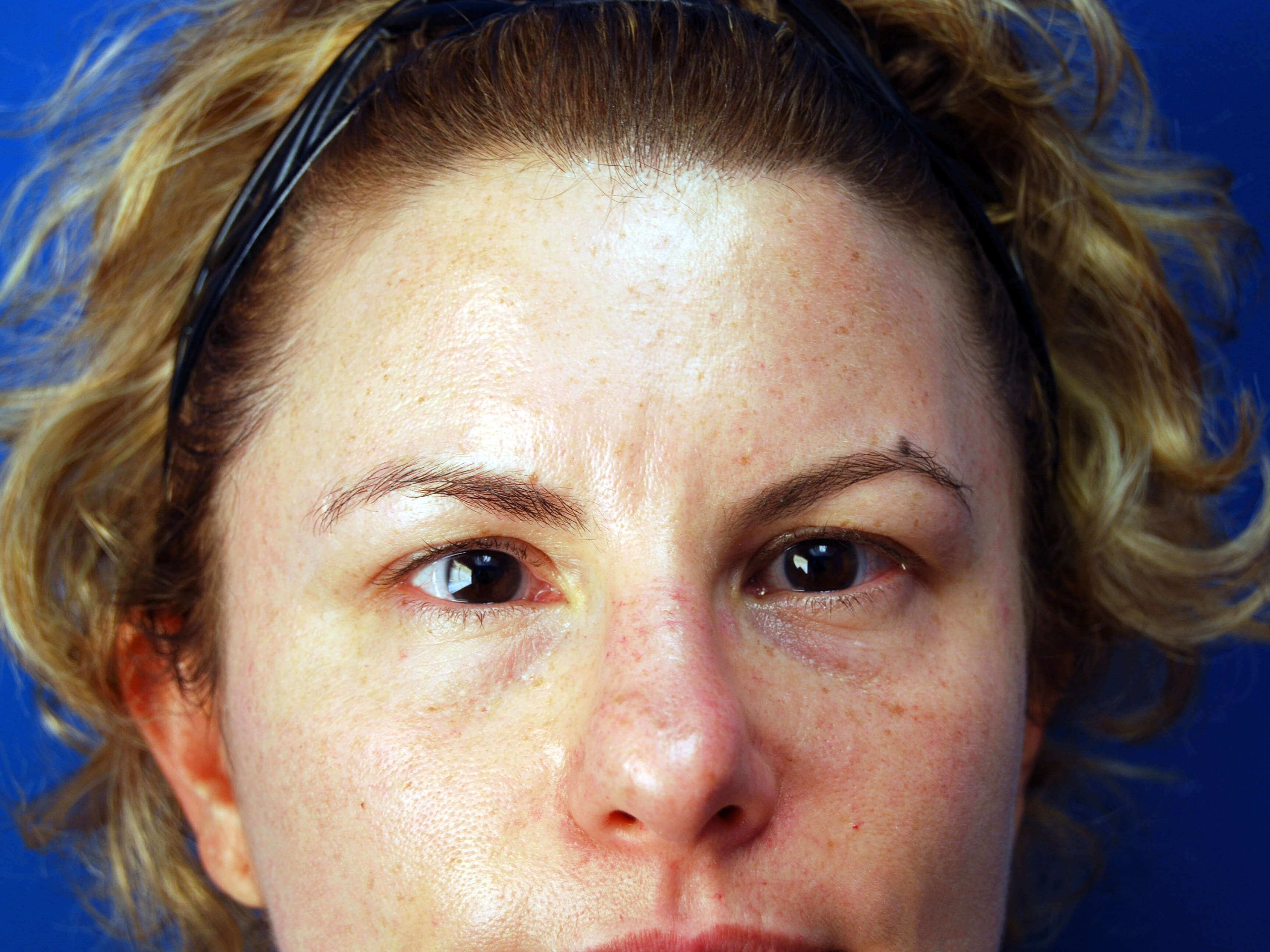 Front View Before Upper Eyelid Lift