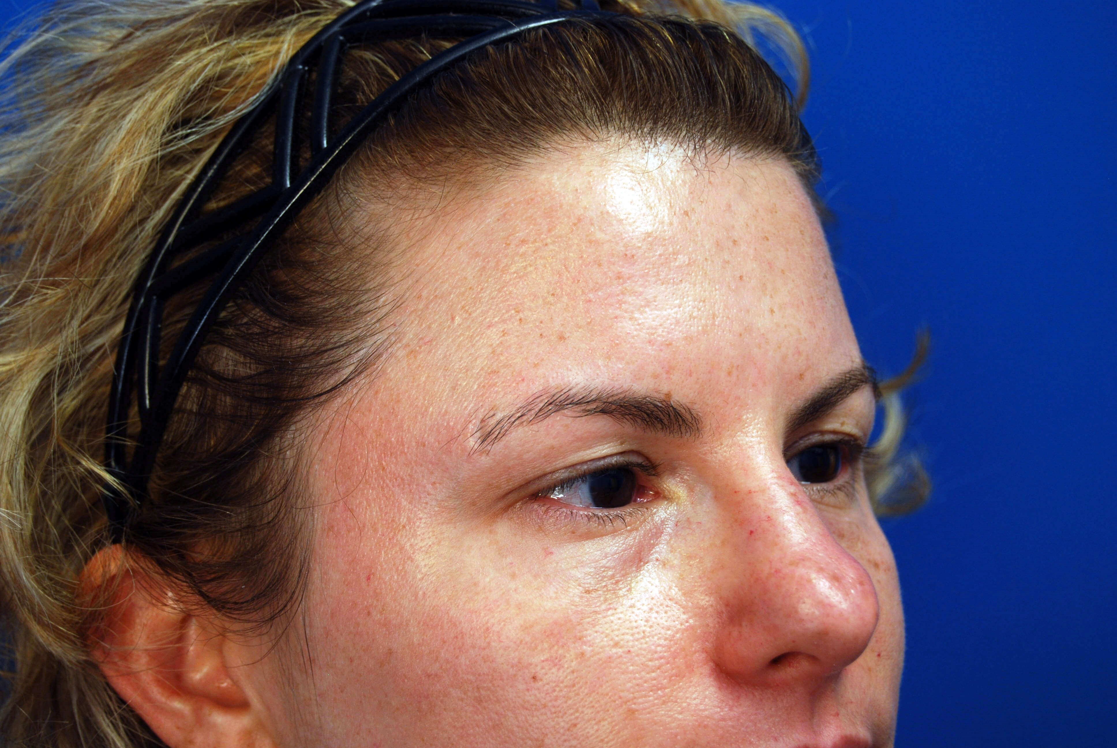 Right Side View Before Upper Eyelid Lift
