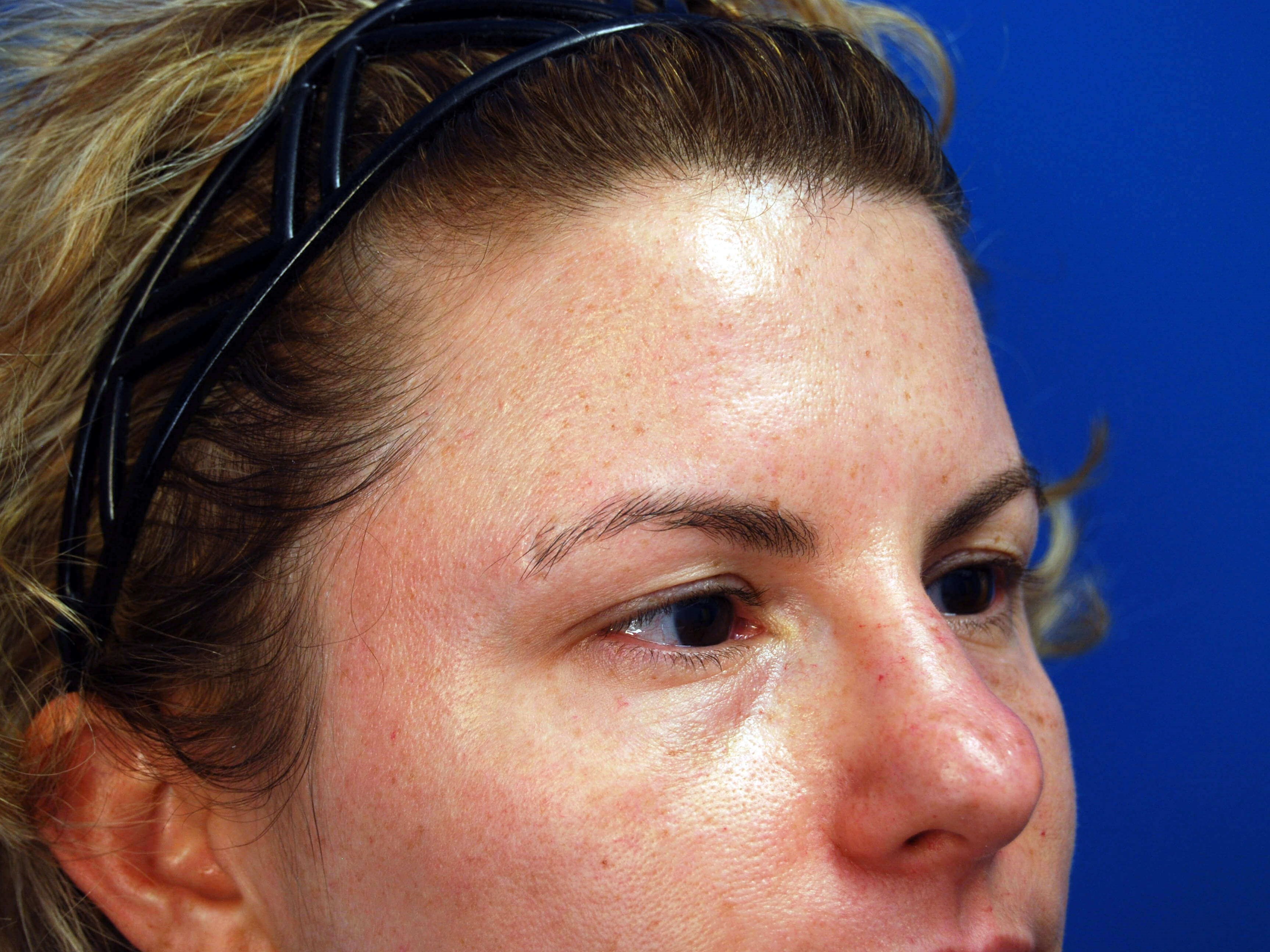 Right Side View Before Upper Eyelid Lift