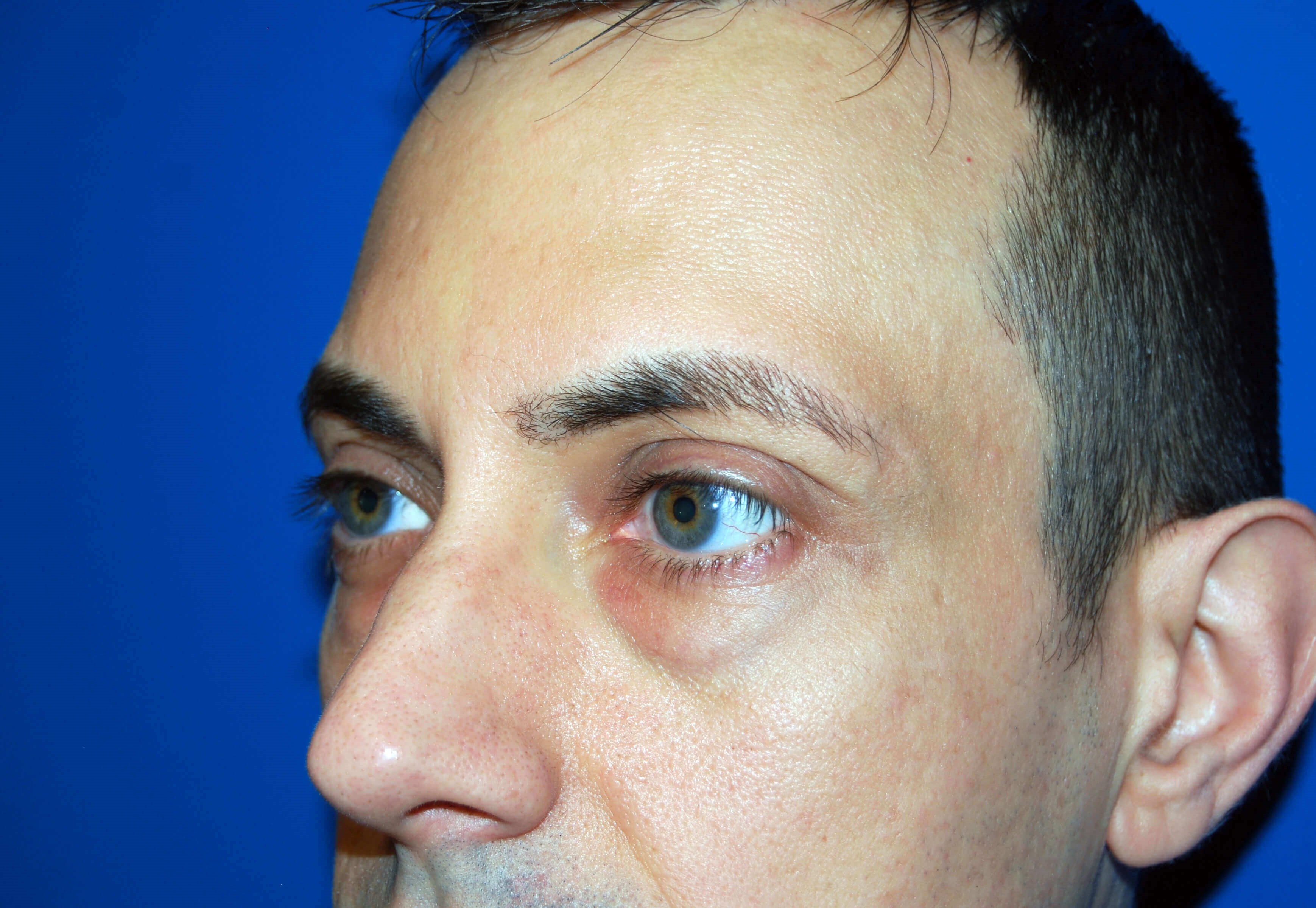 Lower Eyelid - Left Before