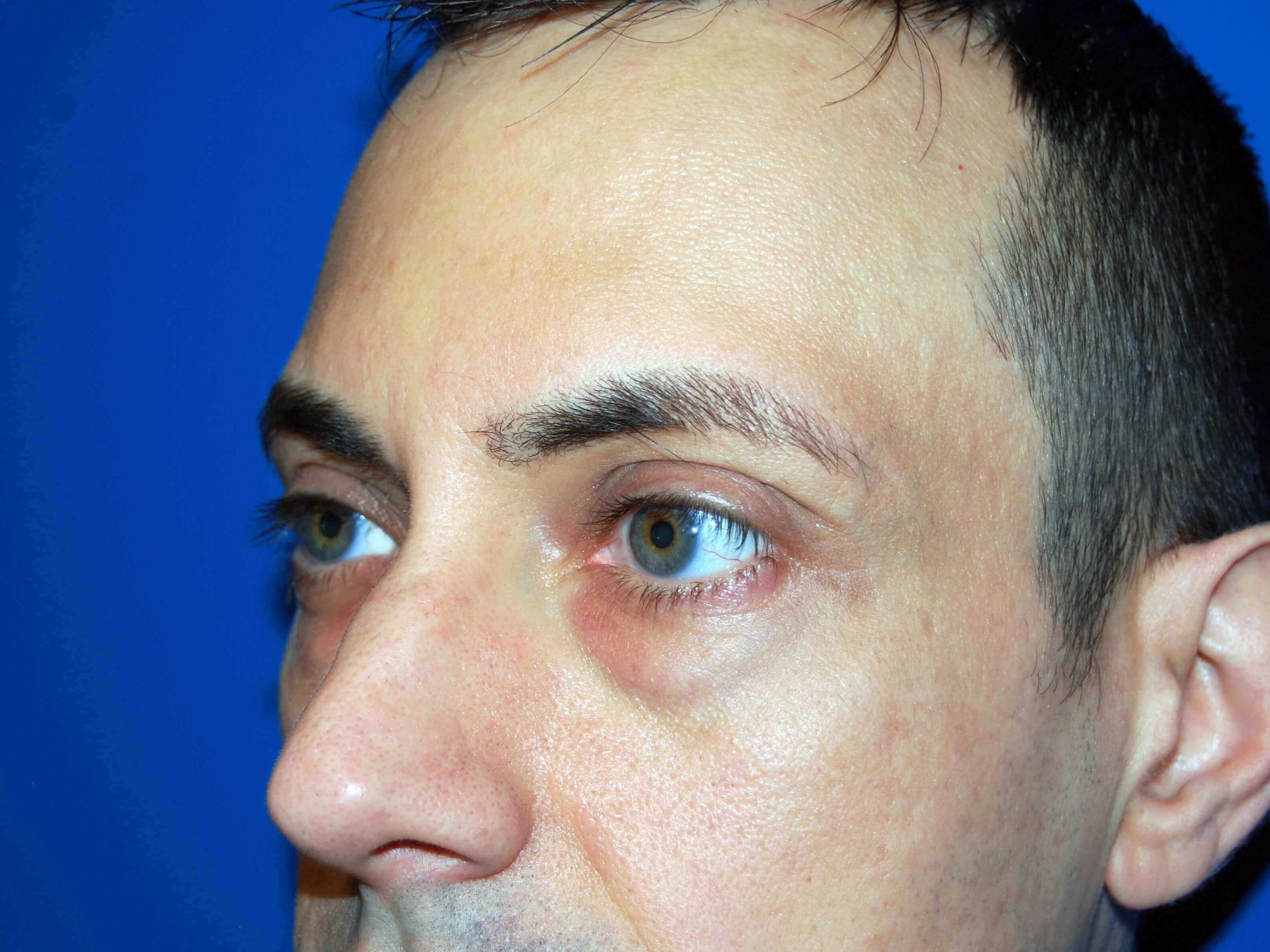 Lower Eyelid - Left Before