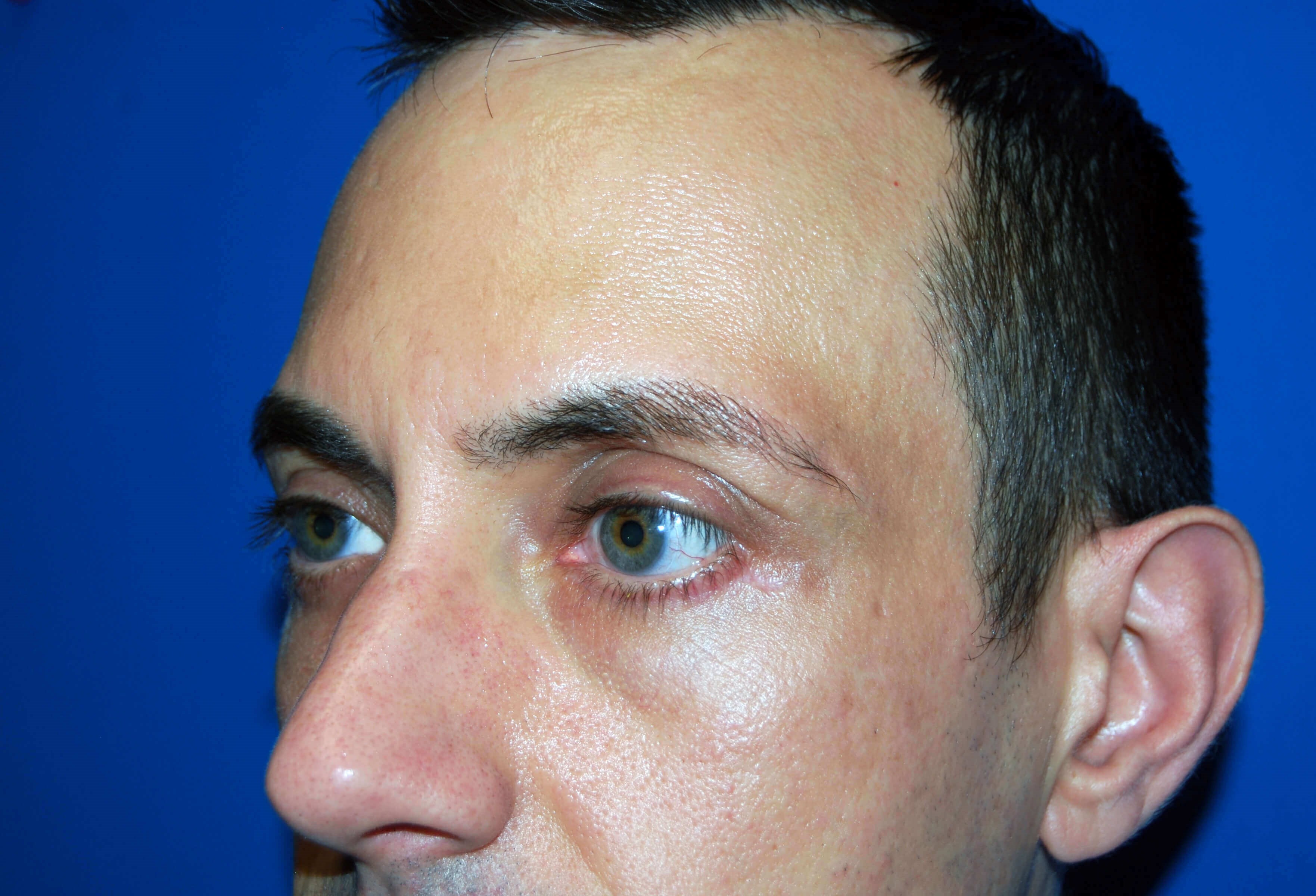 Lower Eyelid - Left After