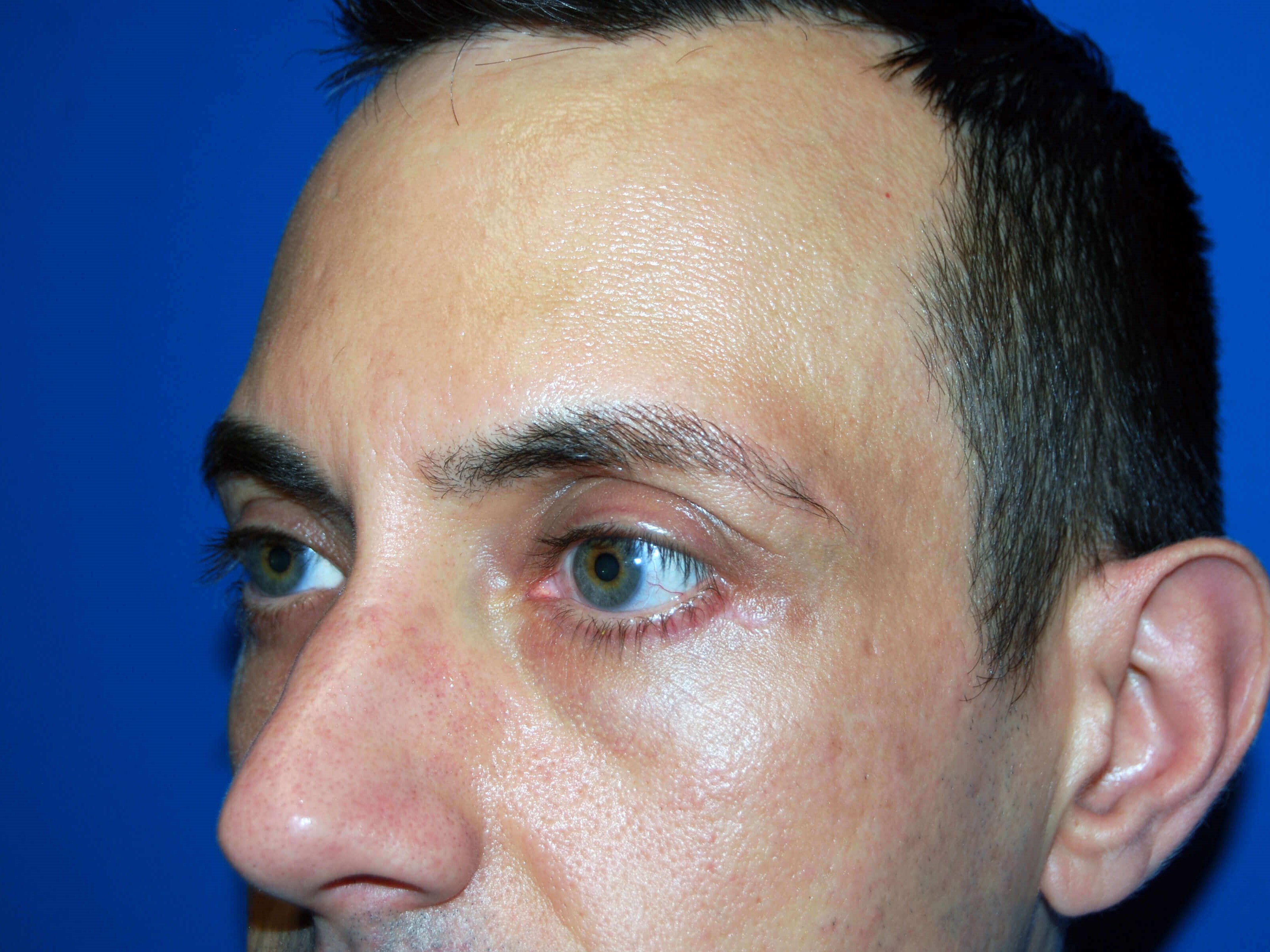 Lower Eyelid - Left After