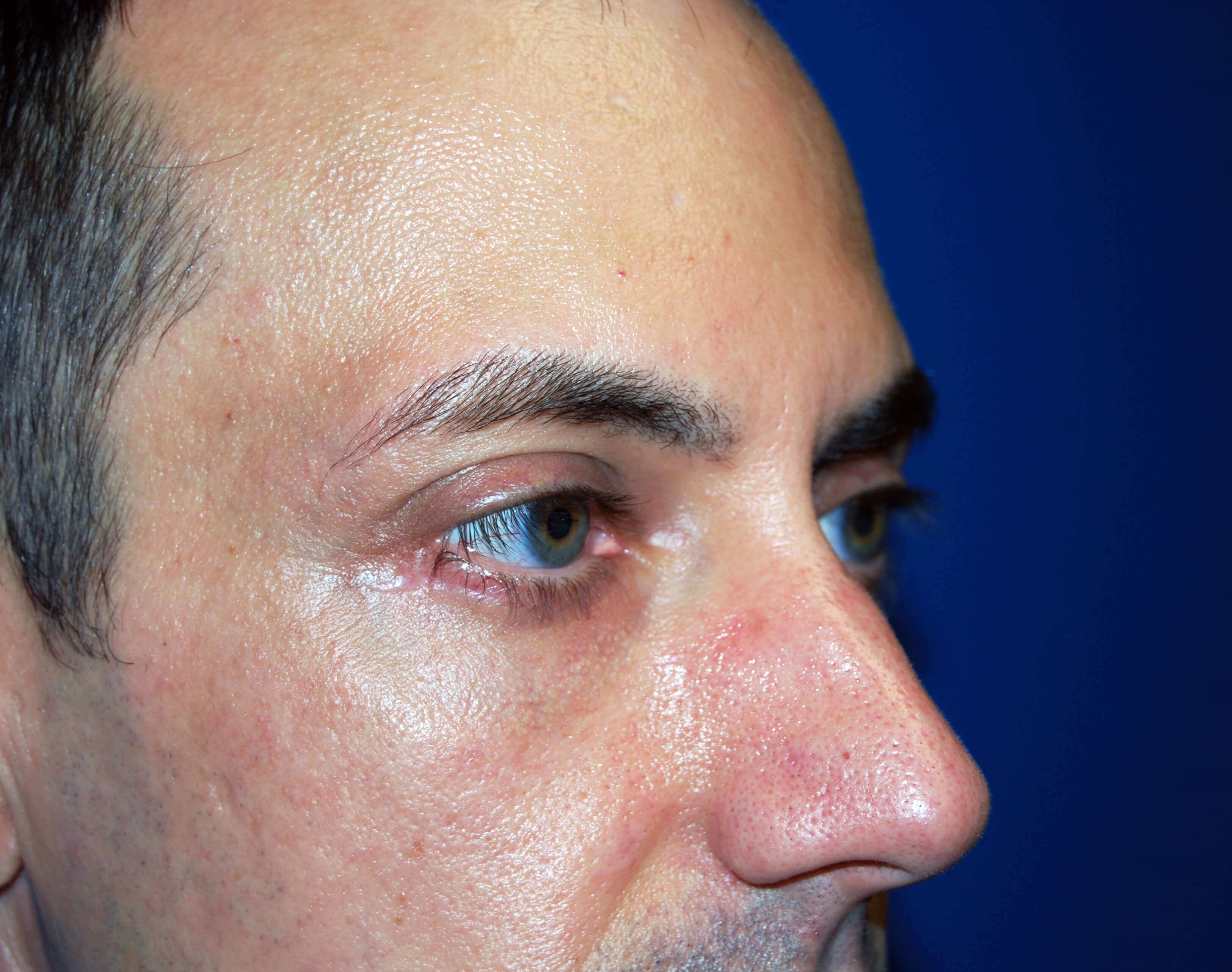 Lower Eyelid - Right After