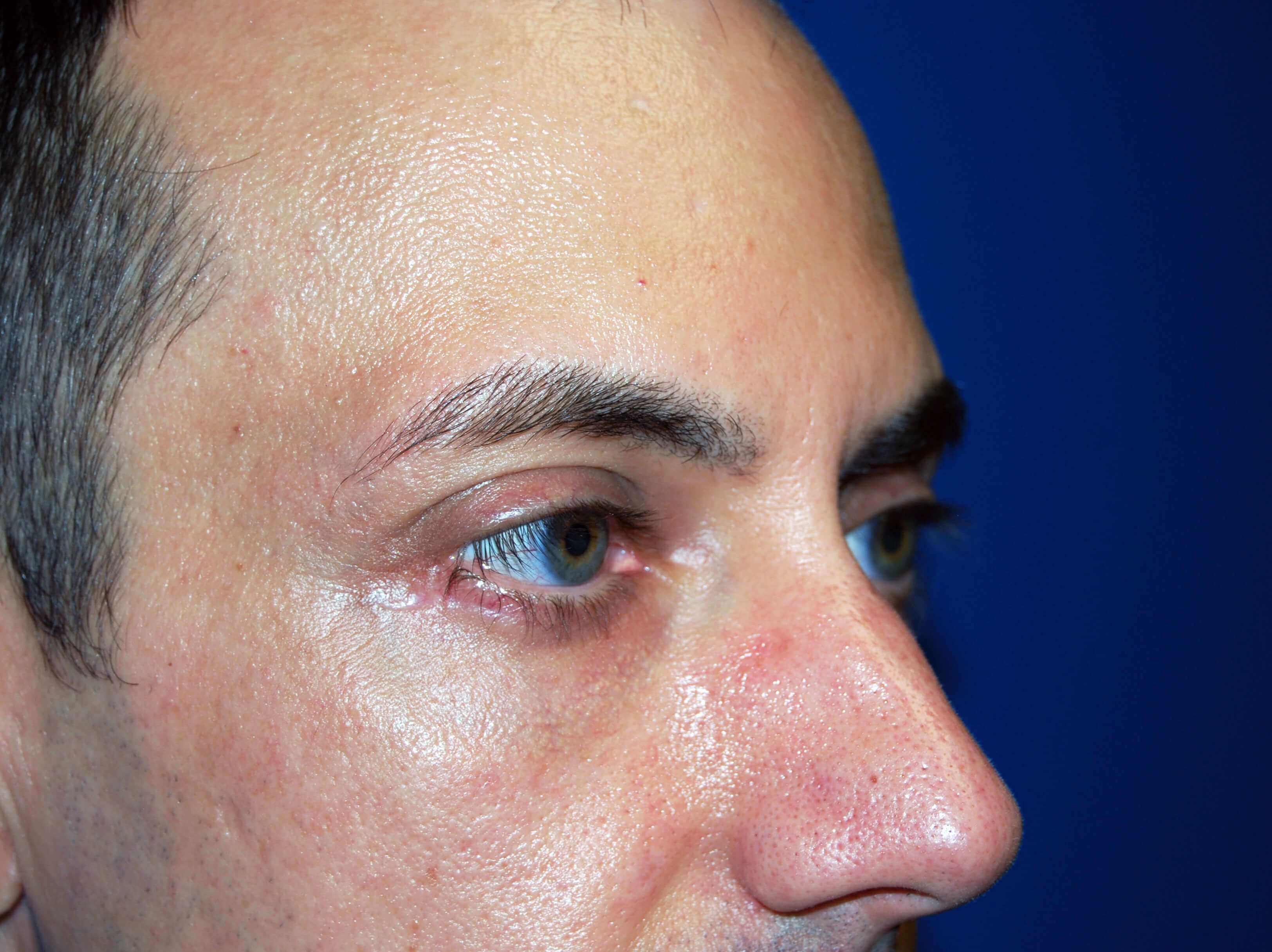 Lower Eyelid - Right After