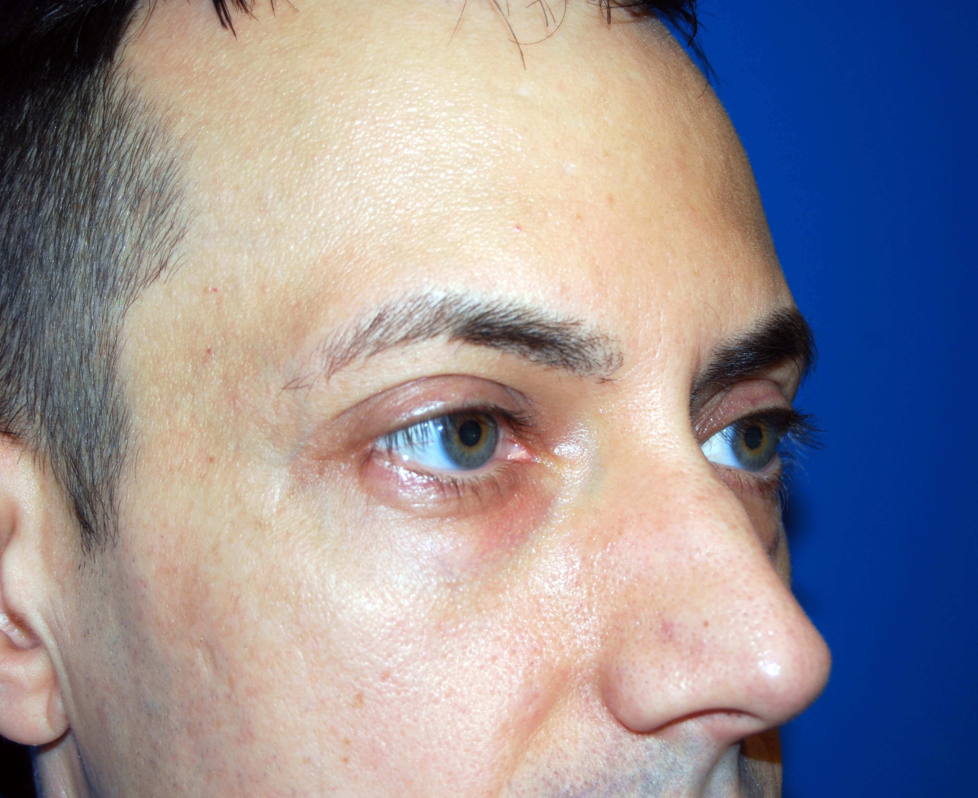 Lower Eyelid - Right Before