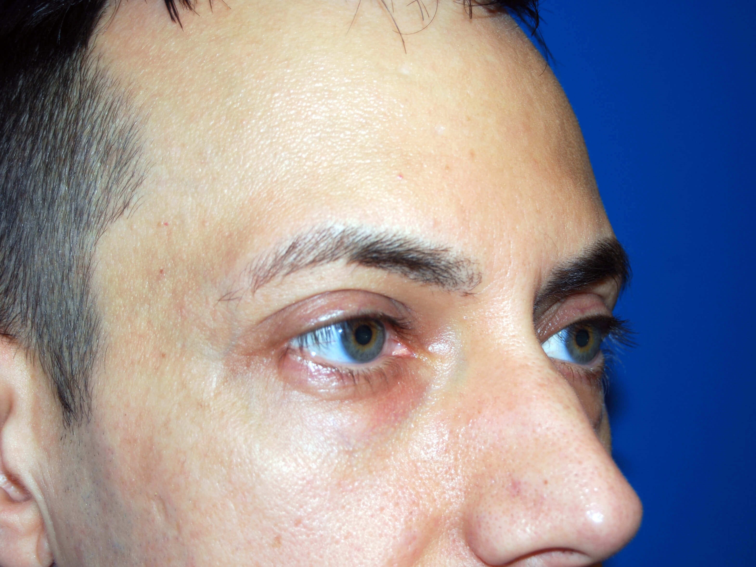 Lower Eyelid - Right Before