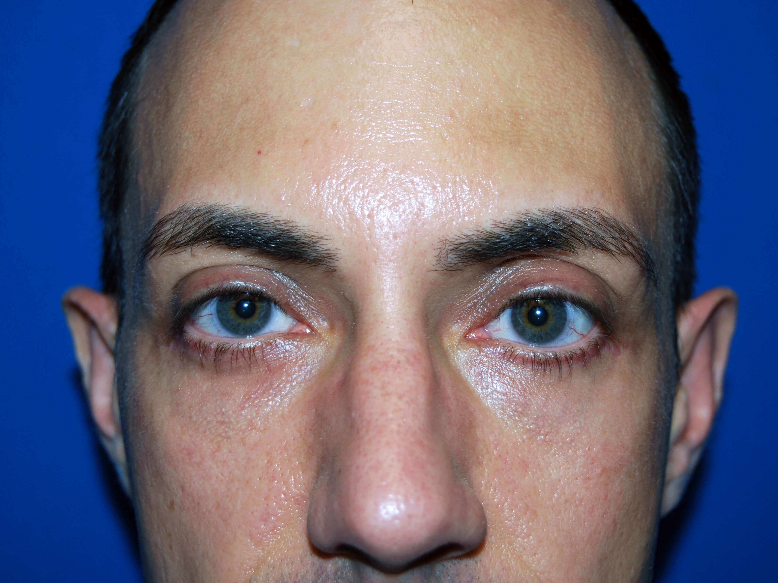 Lower Eyelid - Front After
