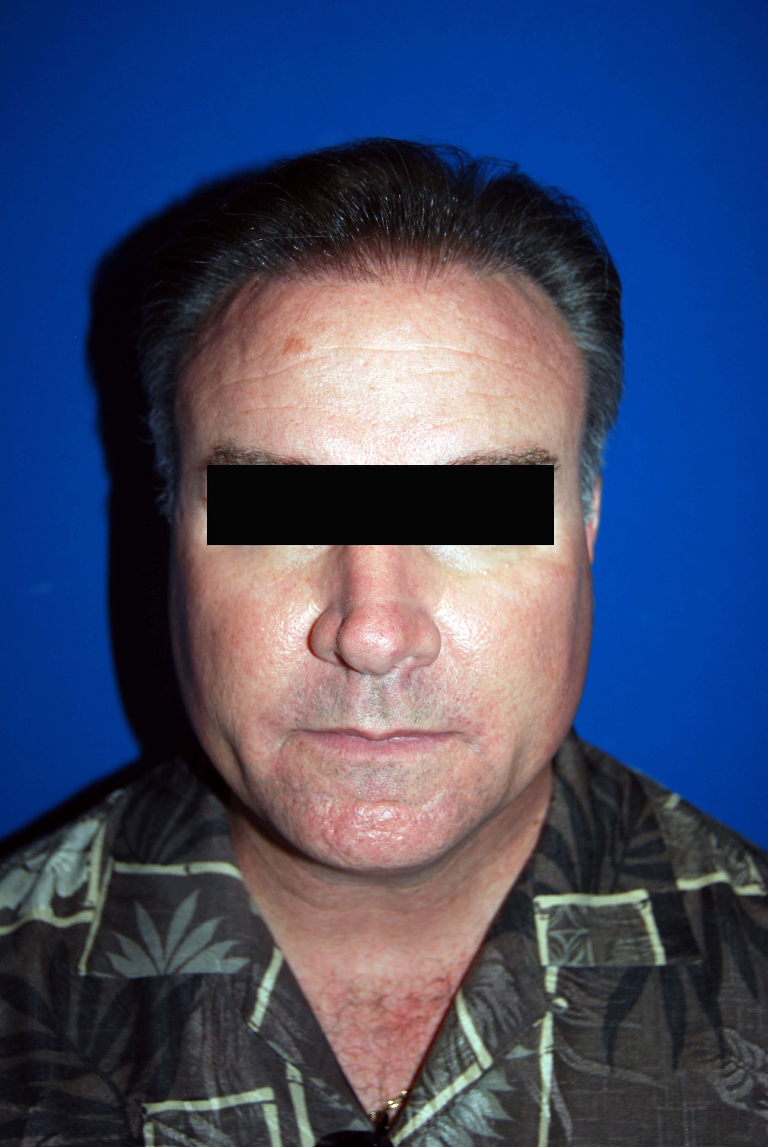 Hair Transplant Before & After After Hair Restoration