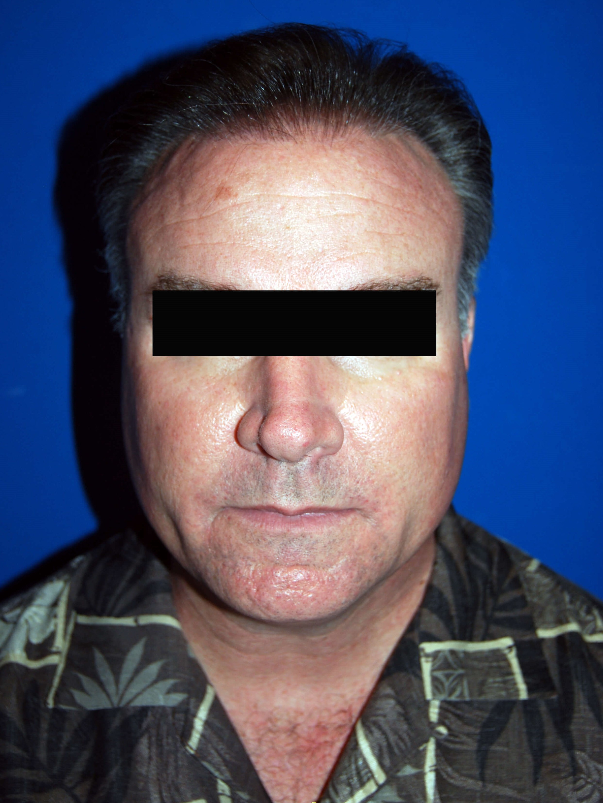 Hair Transplant Before & After After Hair Restoration