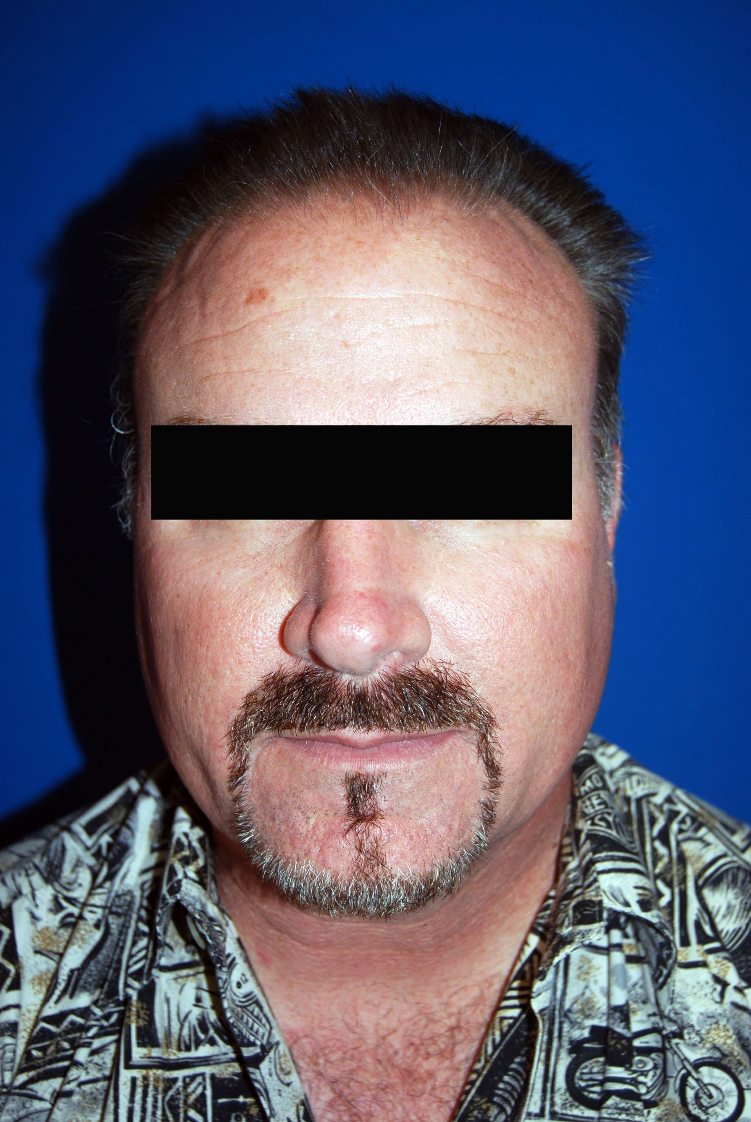 Hair Transplant Before & After Before Hair Restoration