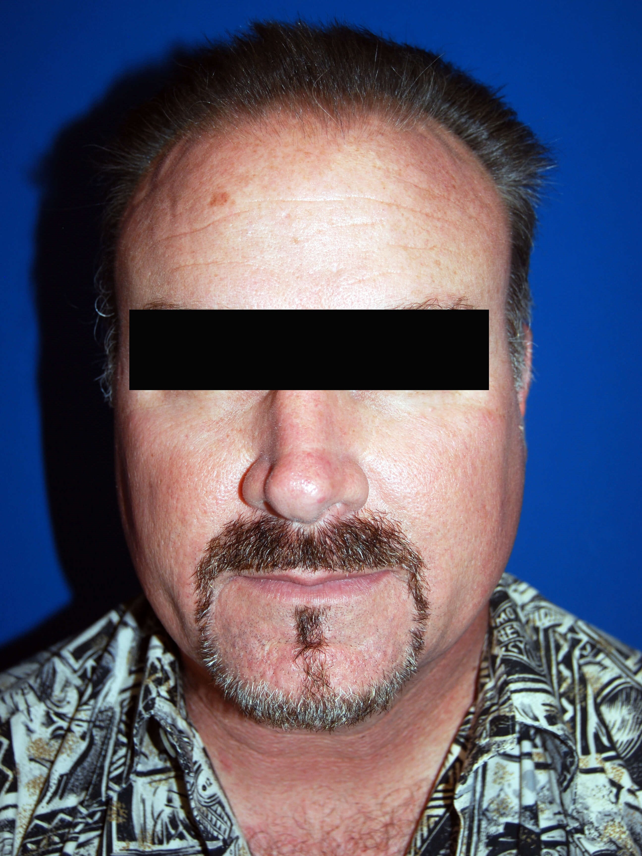 Hair Transplant Before & After Before Hair Restoration