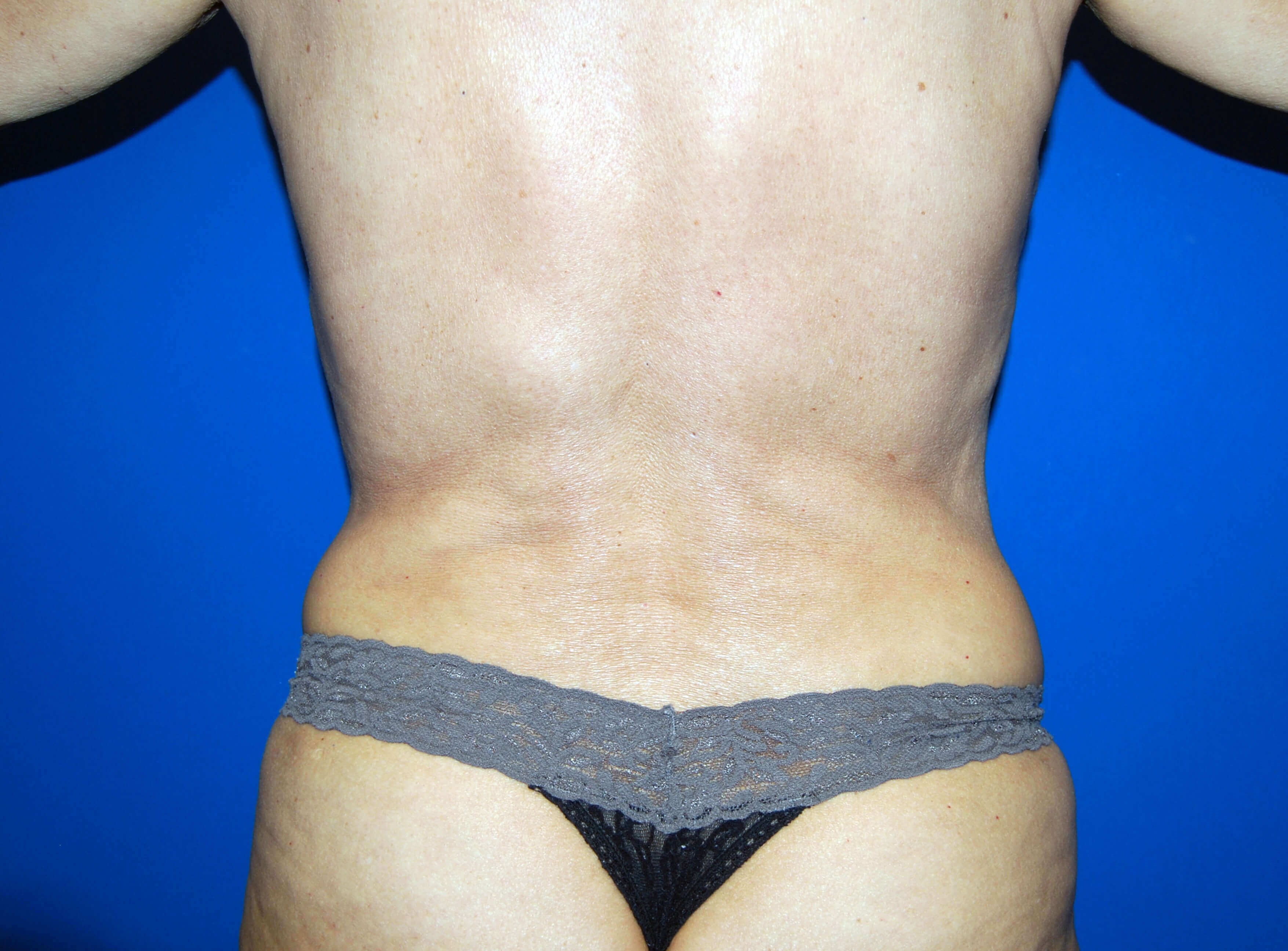 VASER Liposuction After Liposuction
