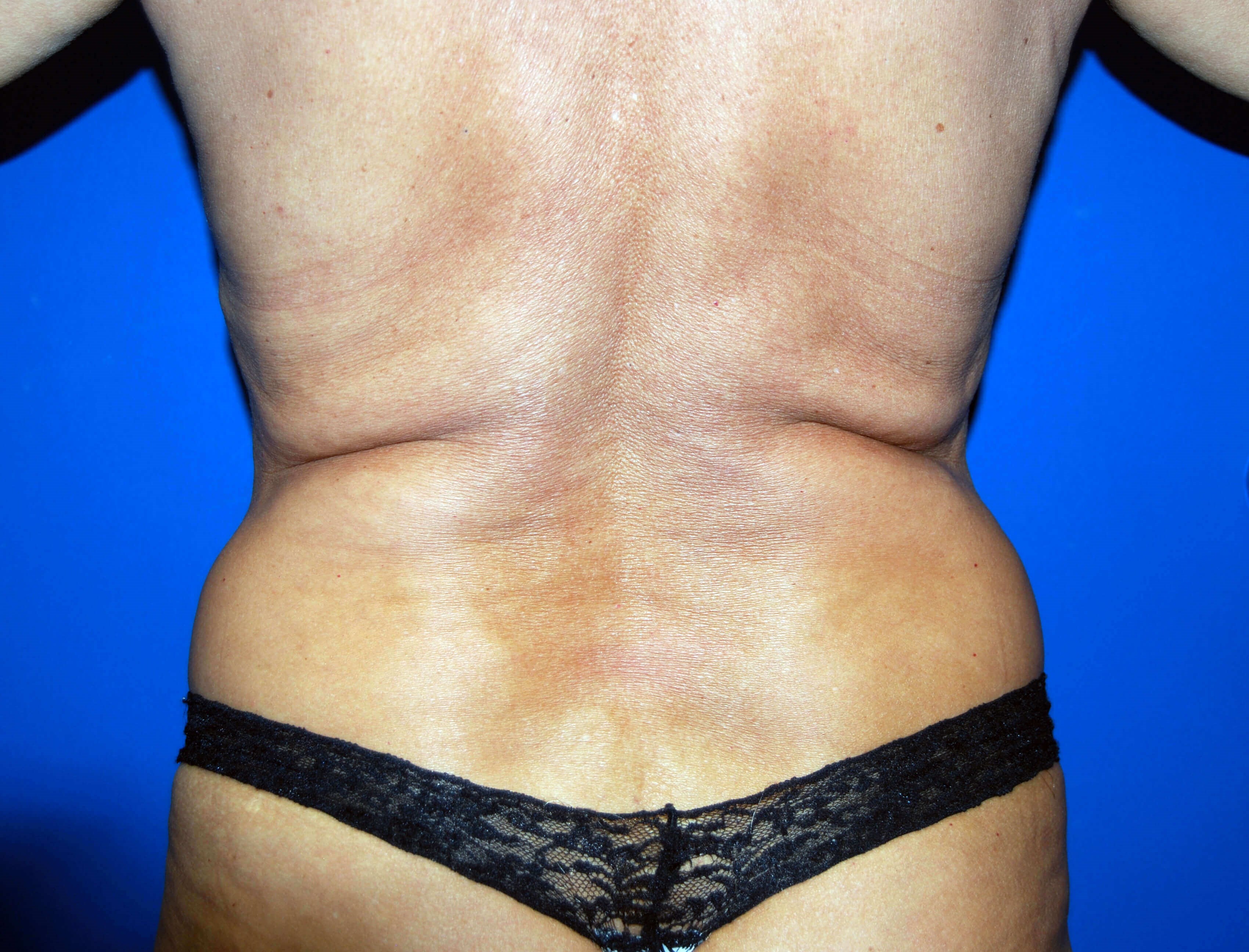 VASER Liposuction Before Liposuction