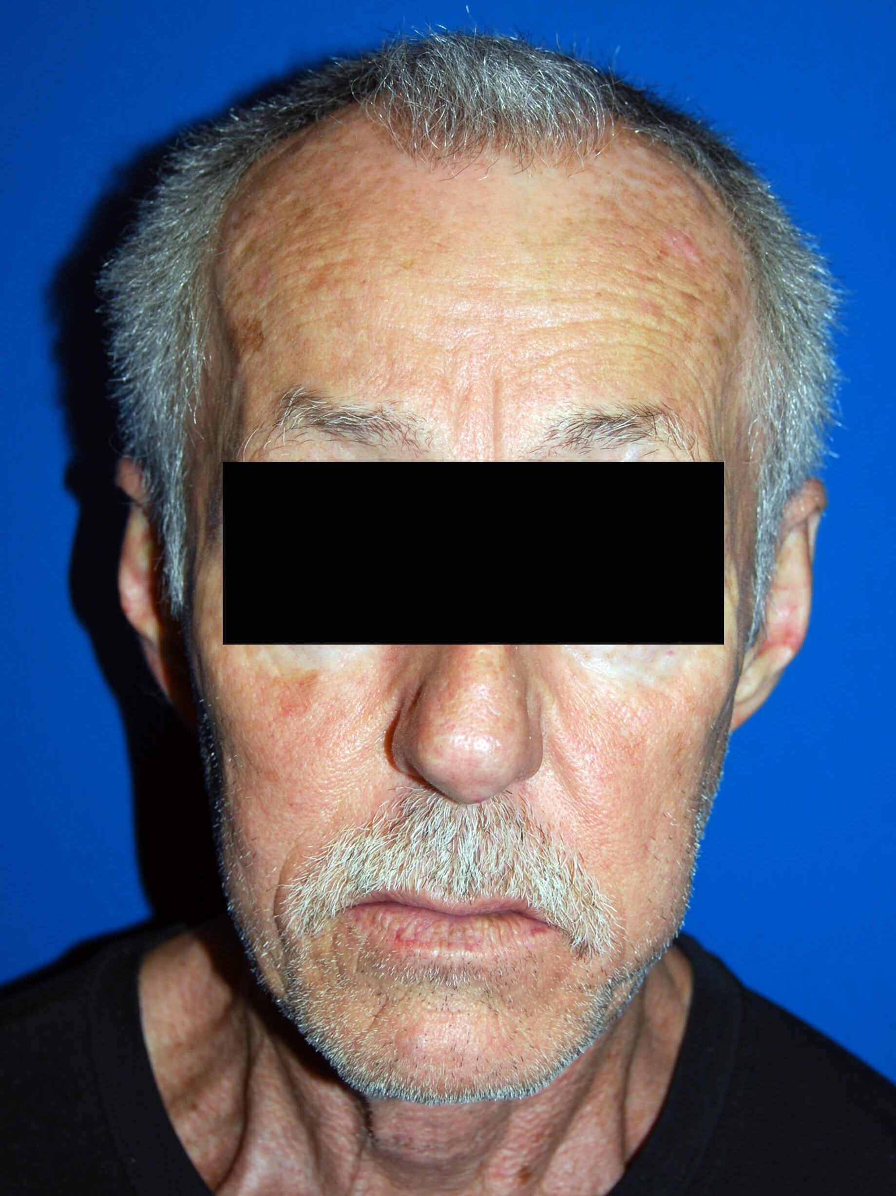 Hair Transplant St. Pete Beach Before Hair Restoration
