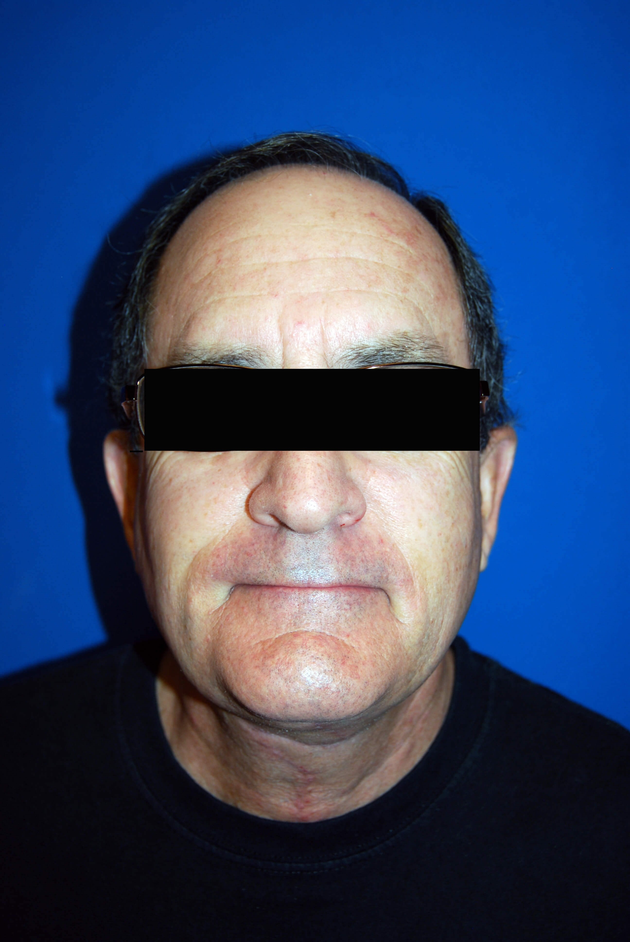 Front After Neck Lift