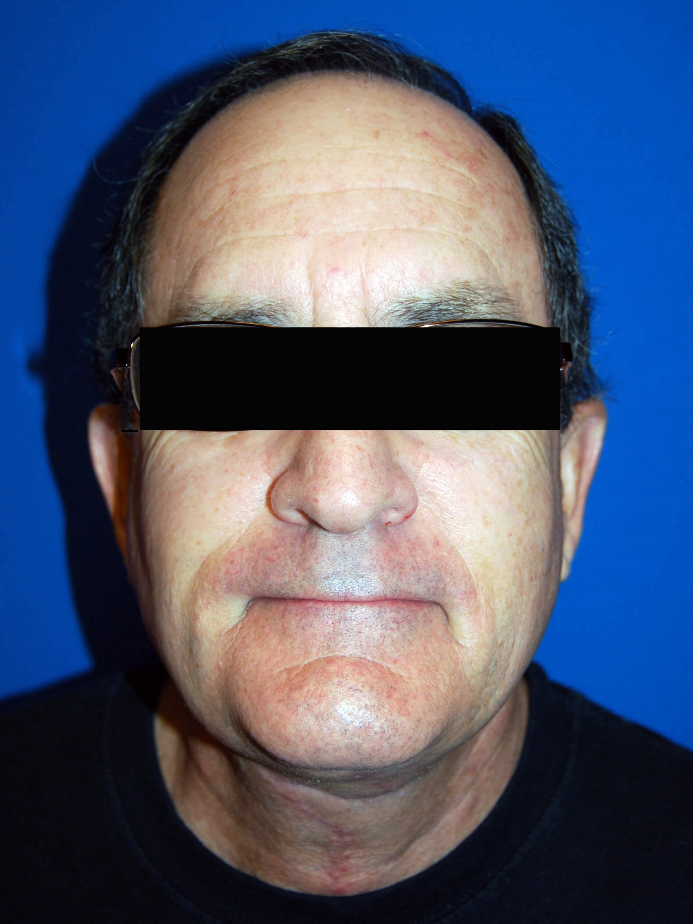 Front After Neck Lift