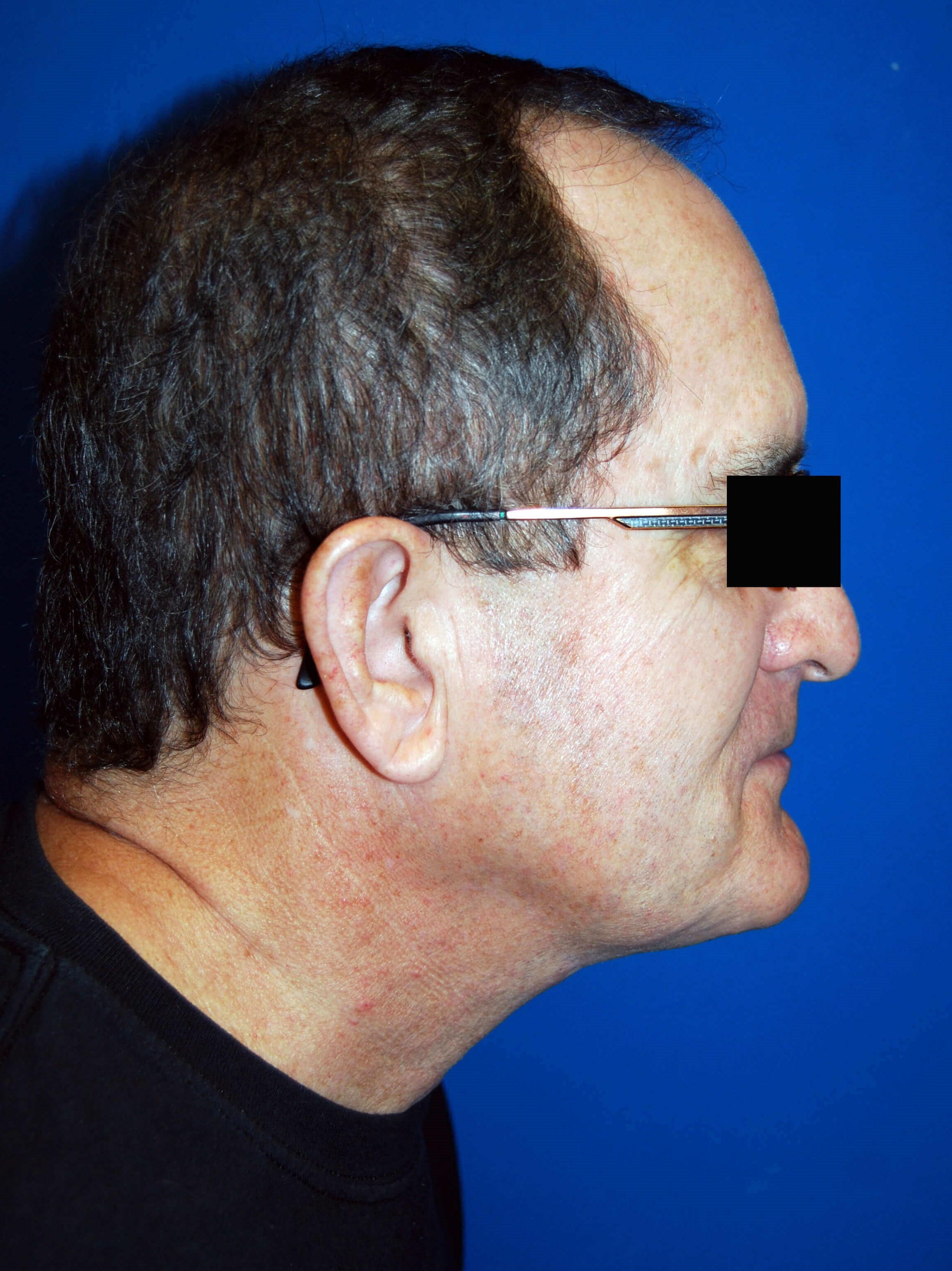 Lateral After