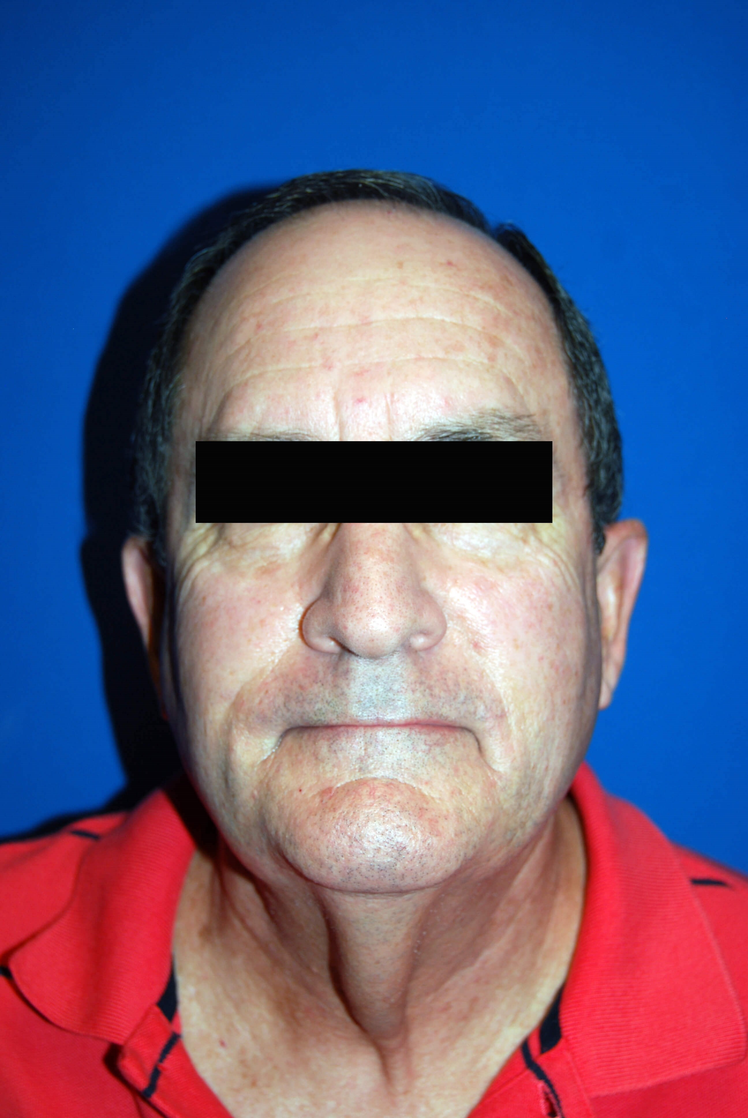 Front Before Neck Lift