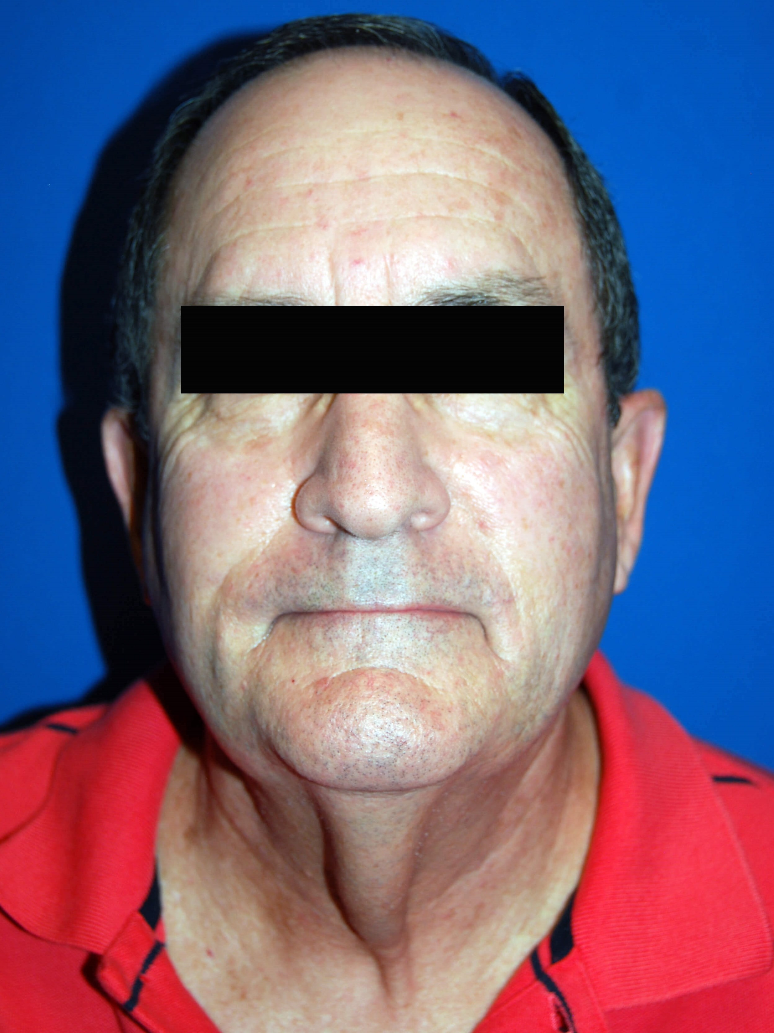 Front Before Neck Lift