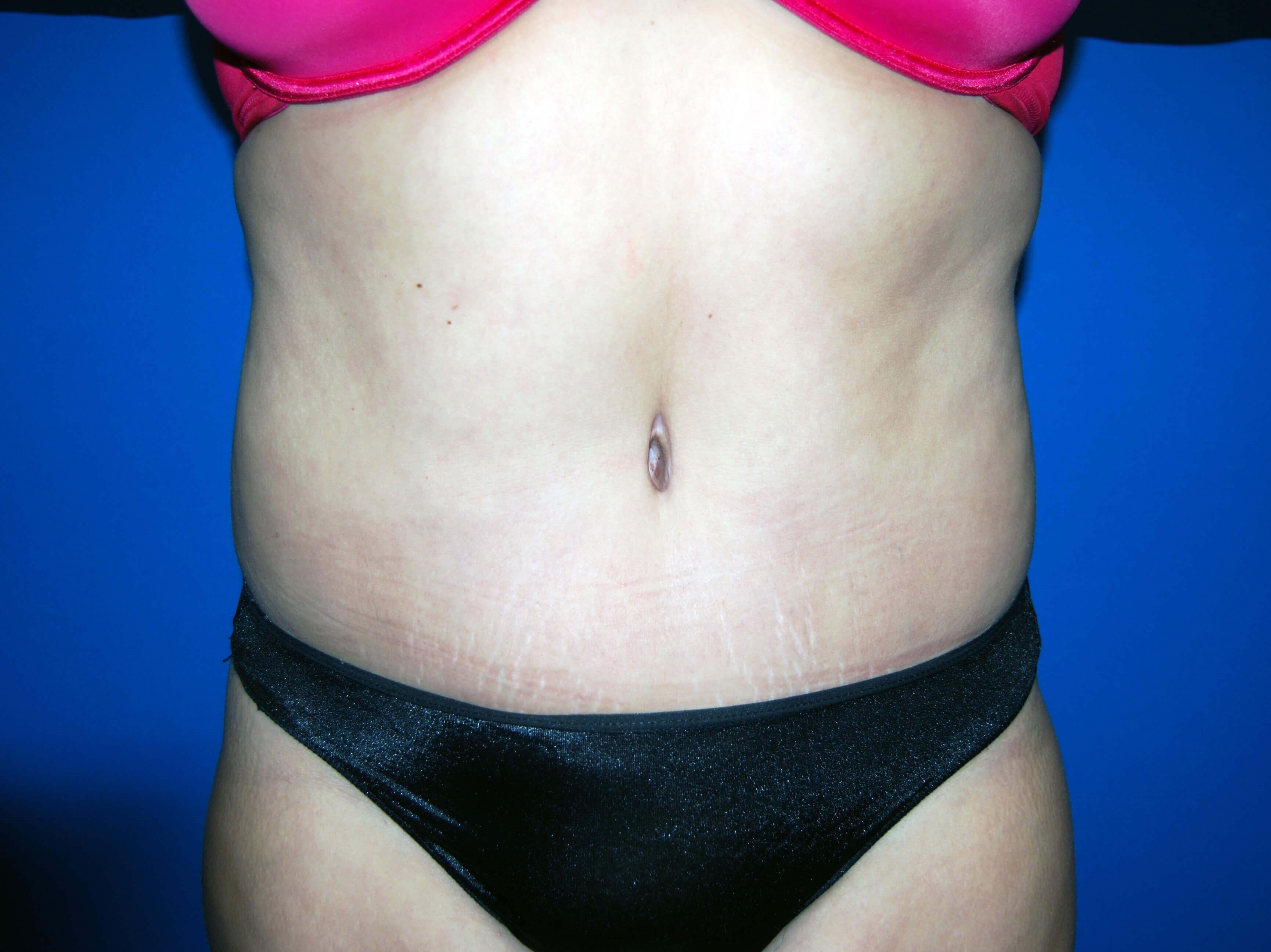 Front After Tummy Tuck