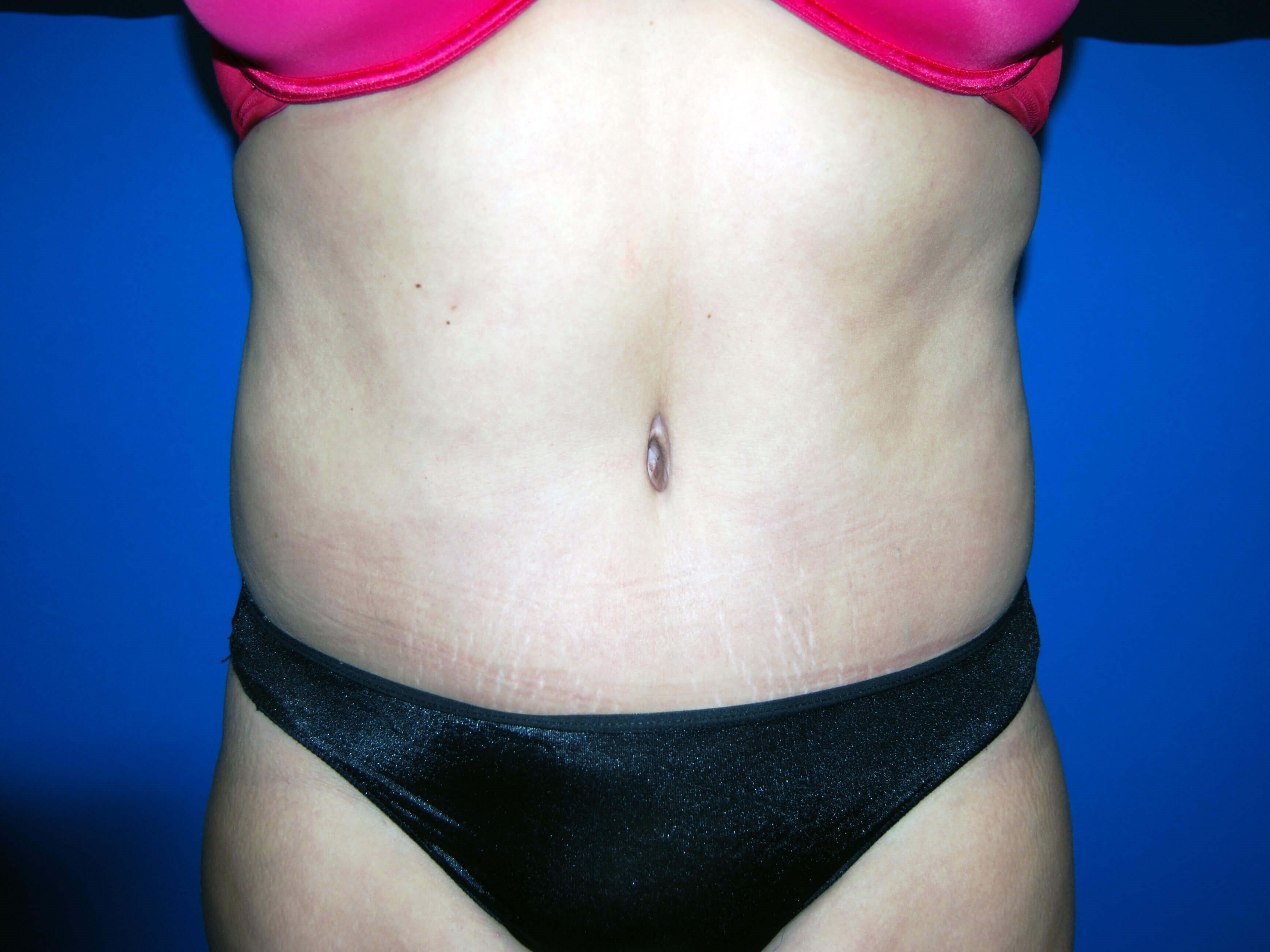 Front After Tummy Tuck