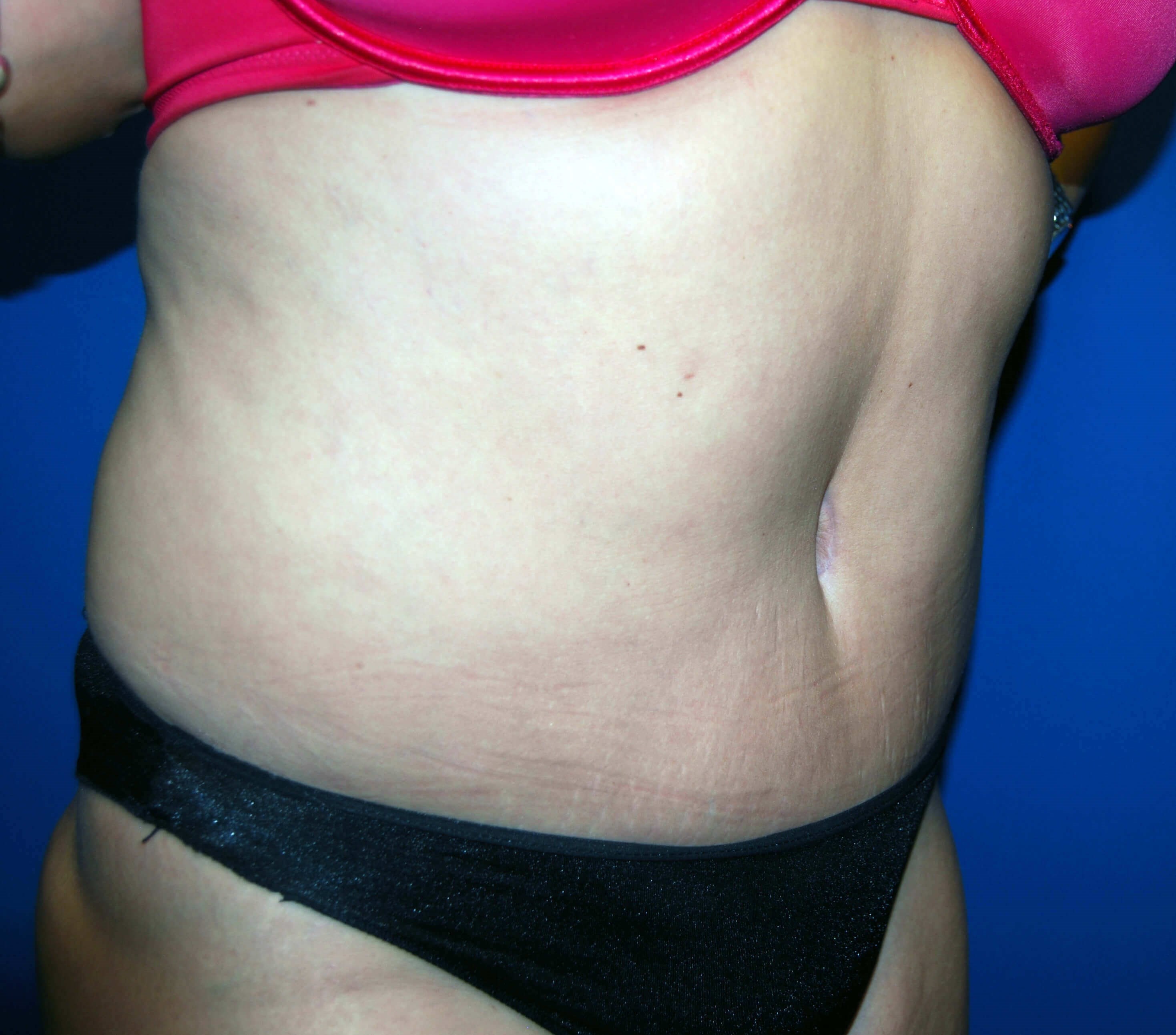 Right After Tummy Tuck