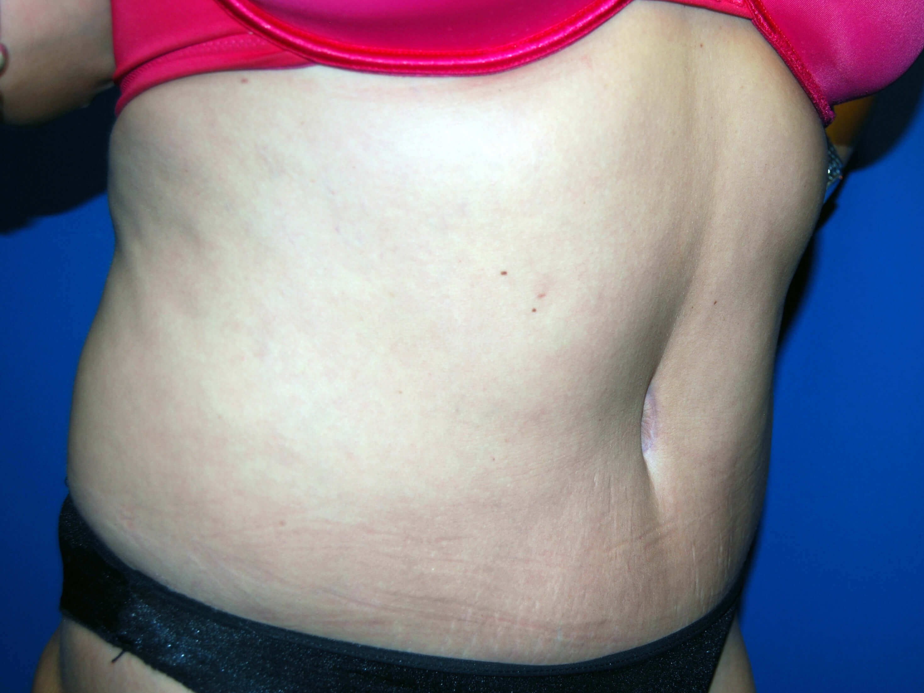 Right After Tummy Tuck