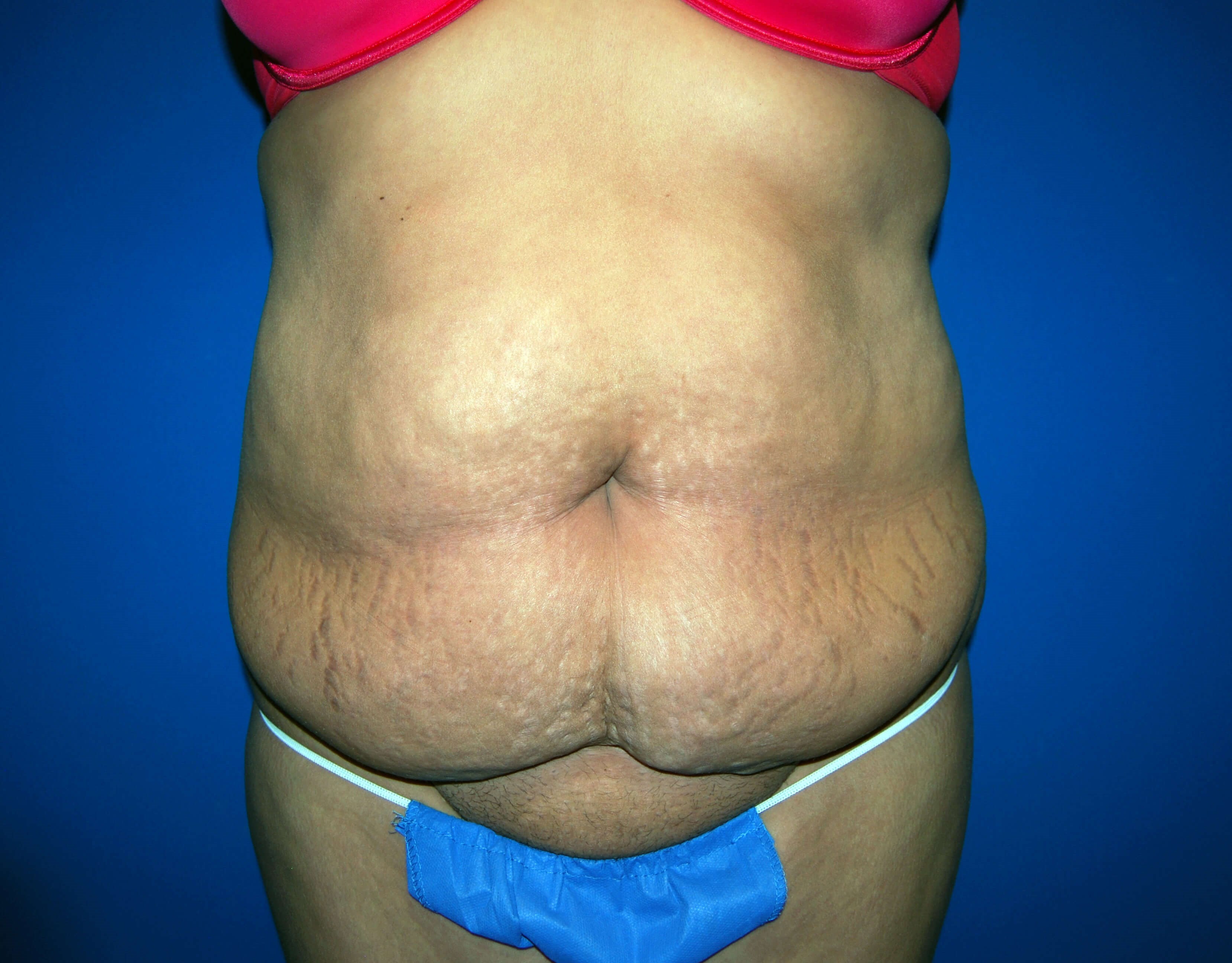Front Before Tummy Tuck