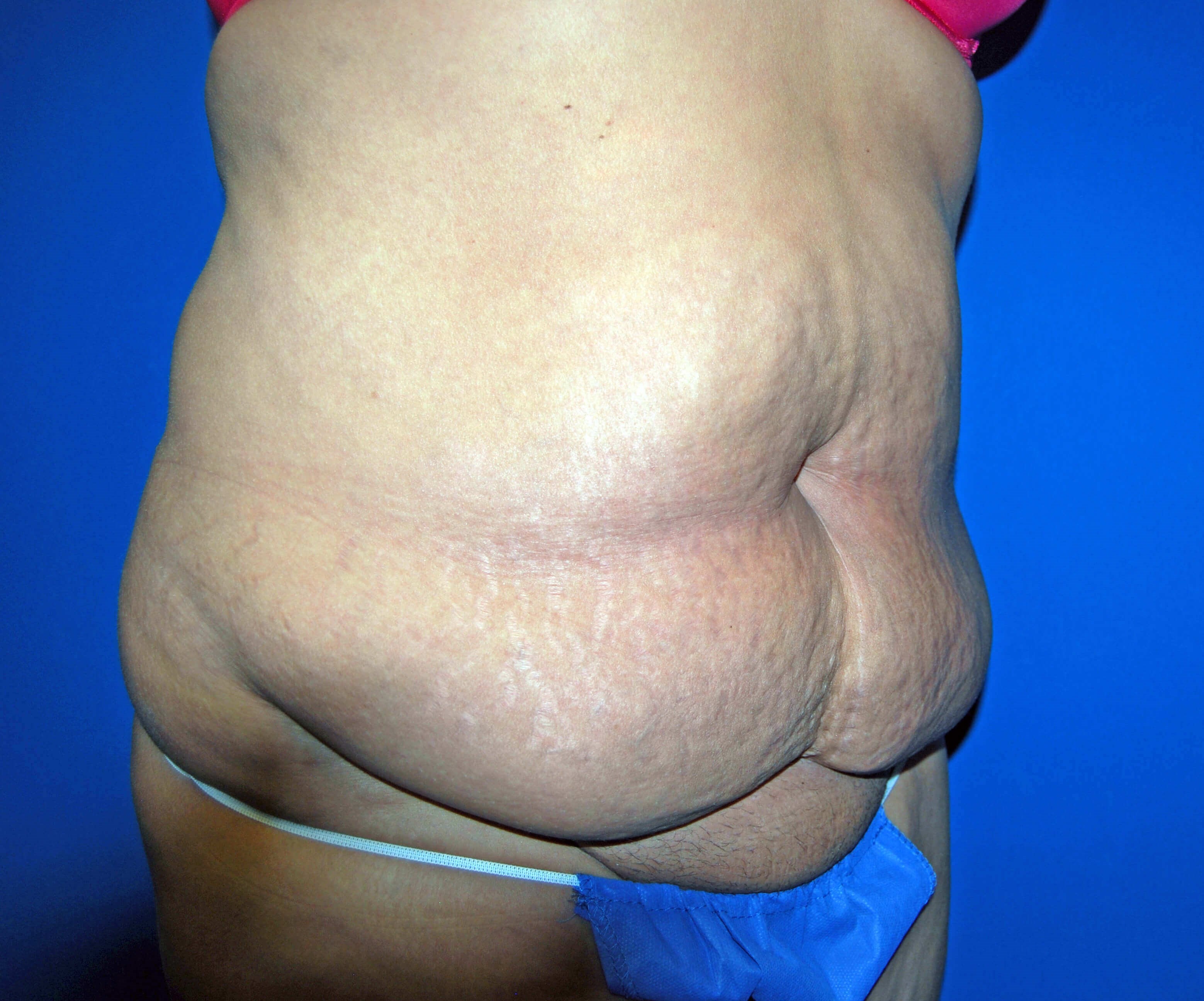 Right Before Tummy Tuck