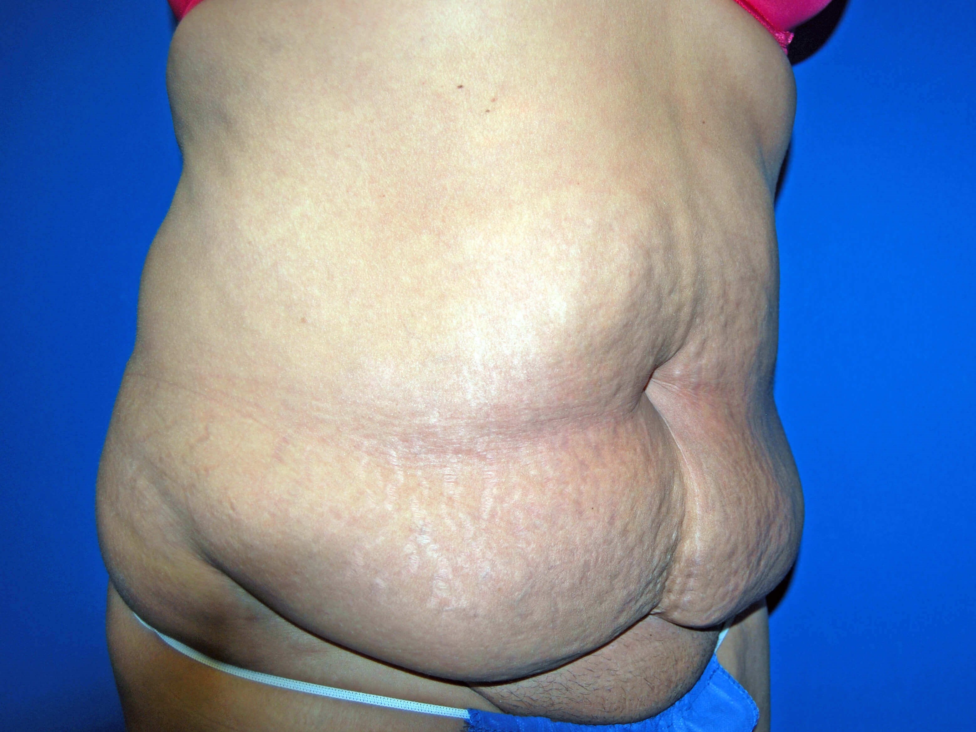 Right Before Tummy Tuck