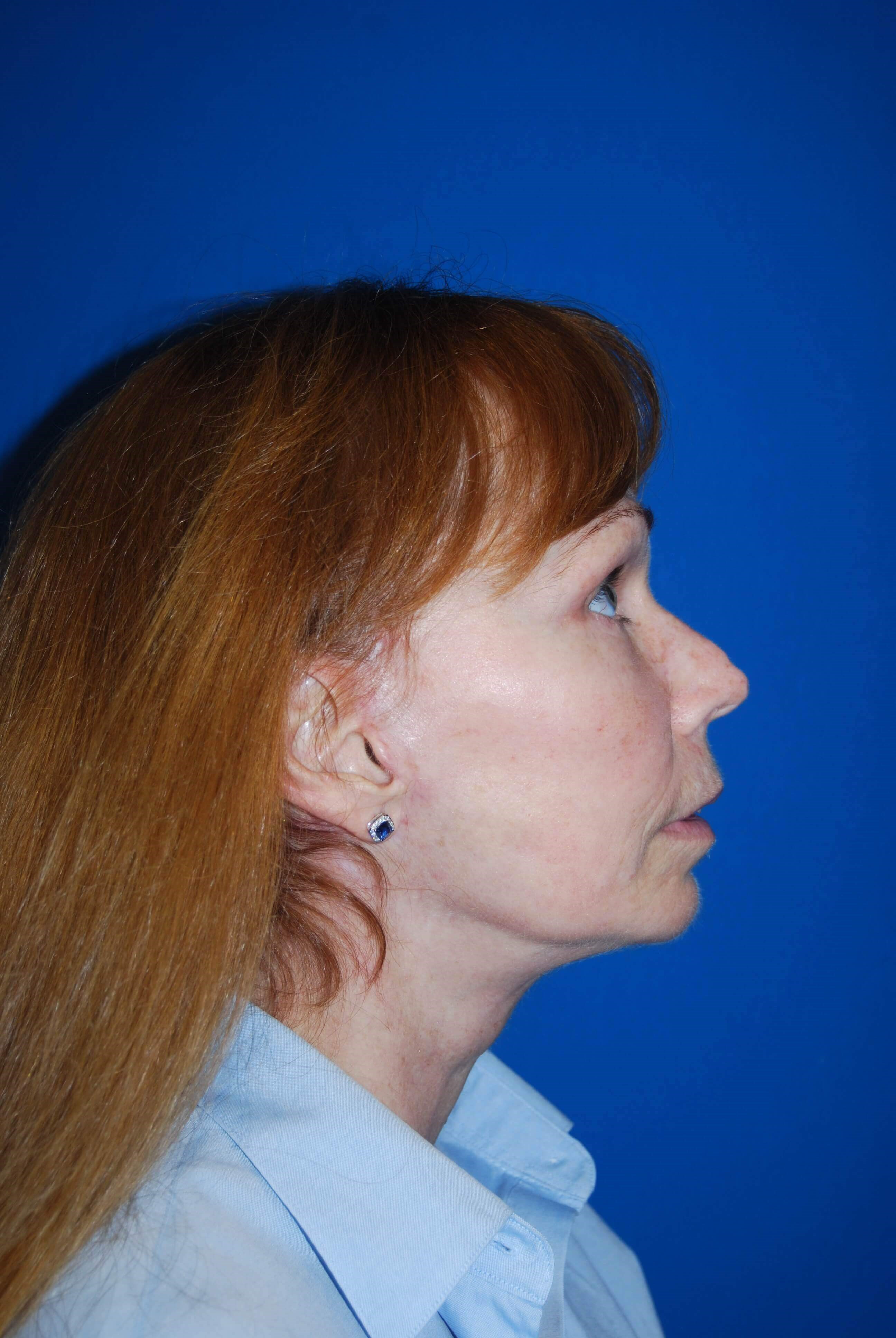 Lateral After
