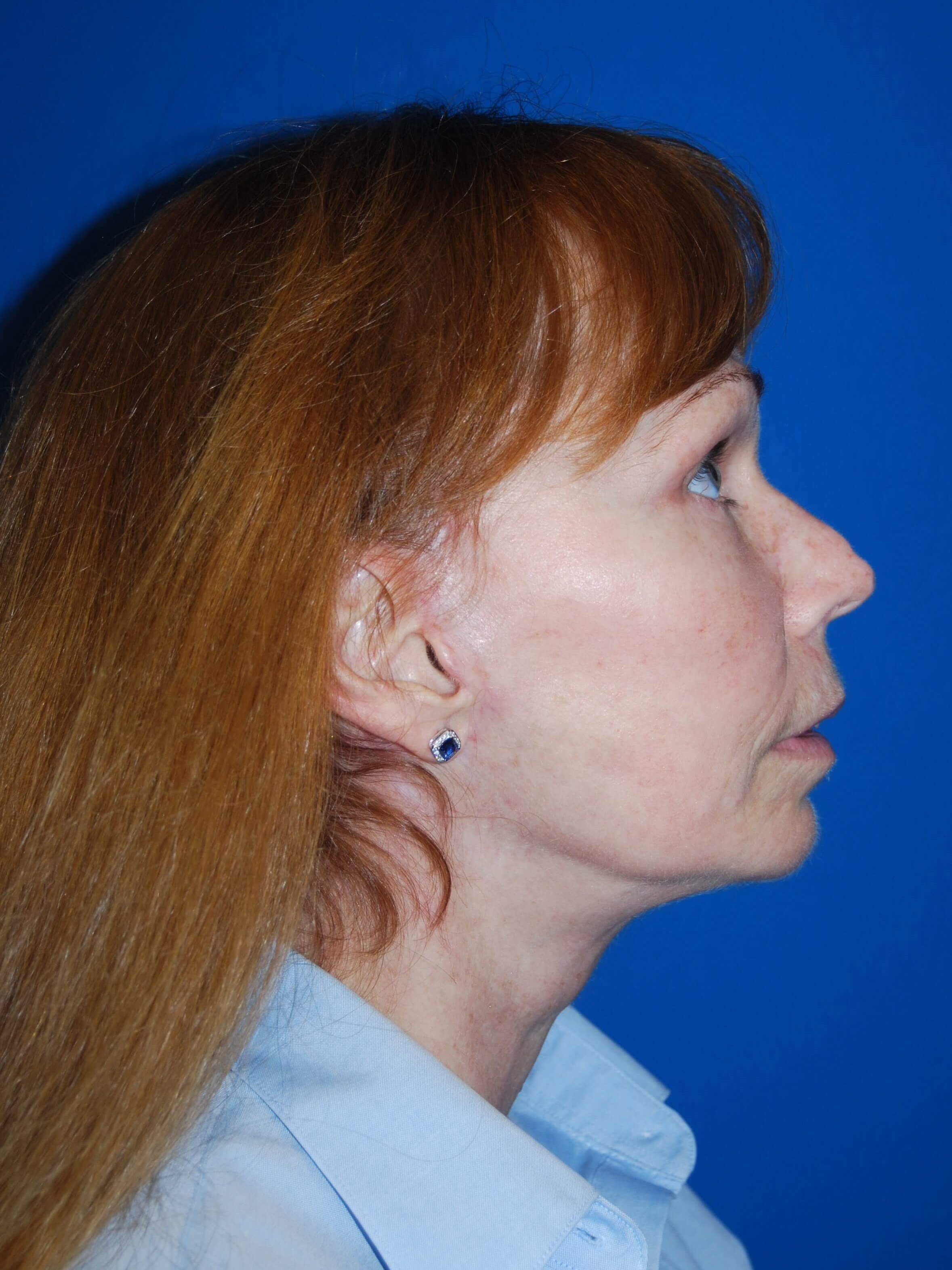 Lateral After
