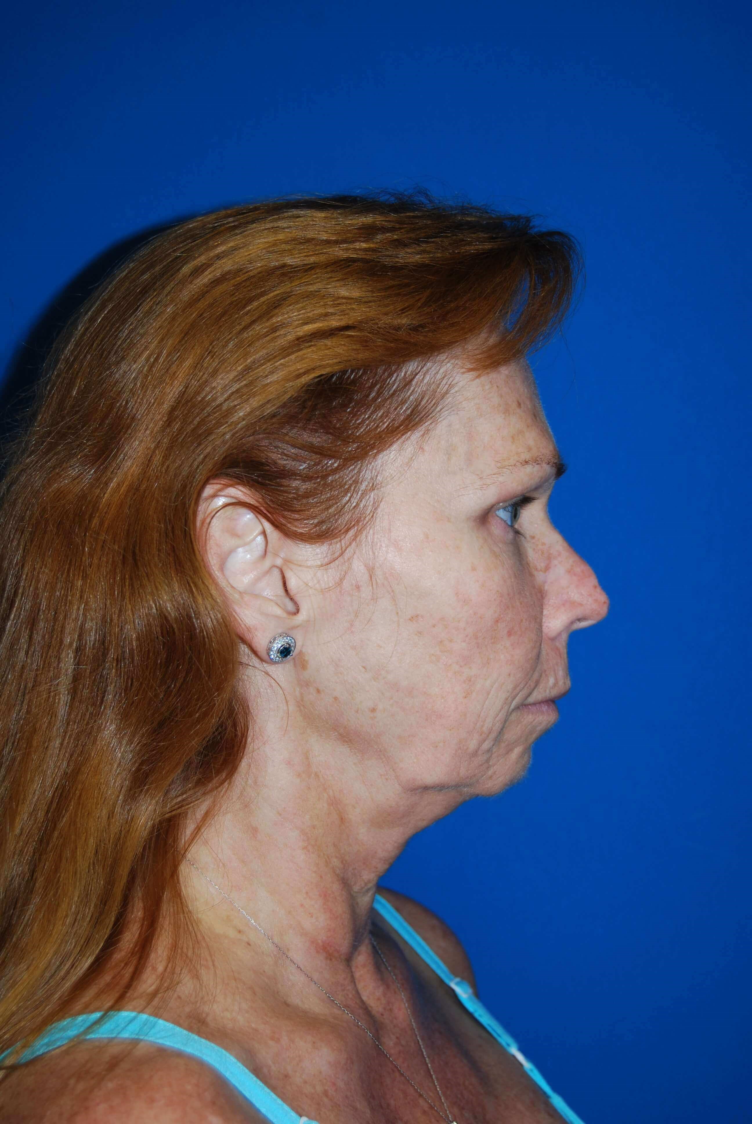 Lateral Before