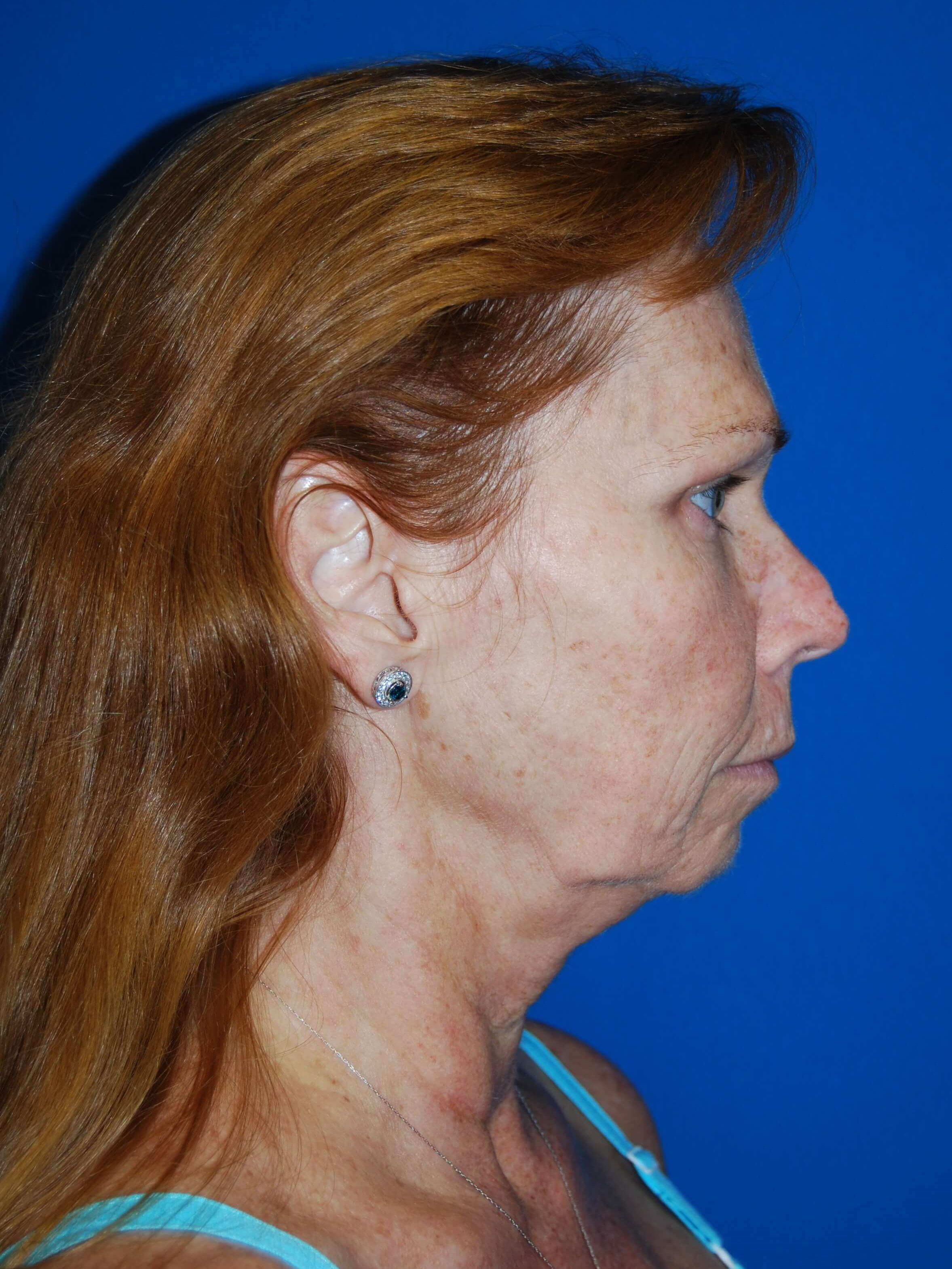 Lateral Before