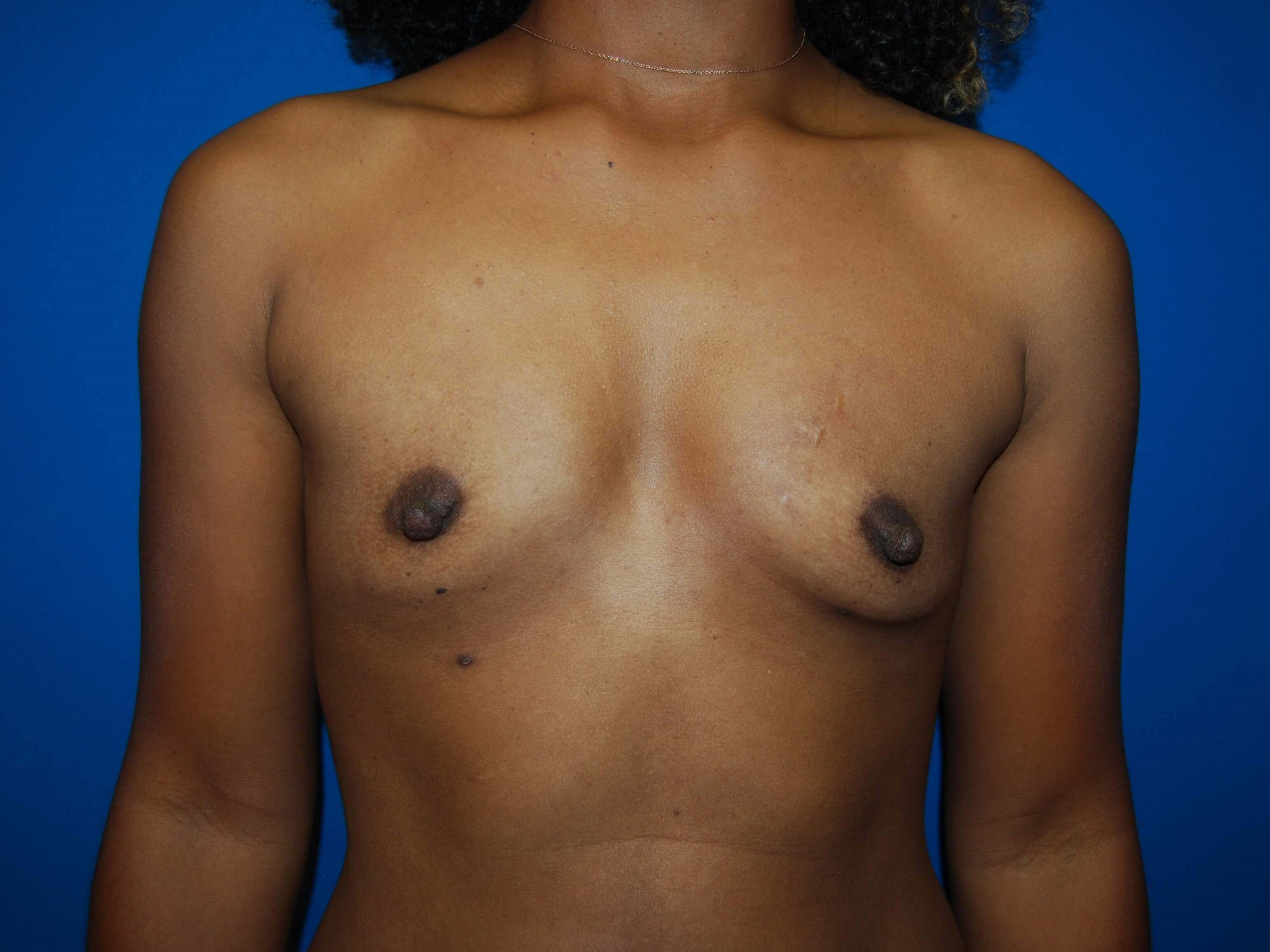 Front Before Implants
