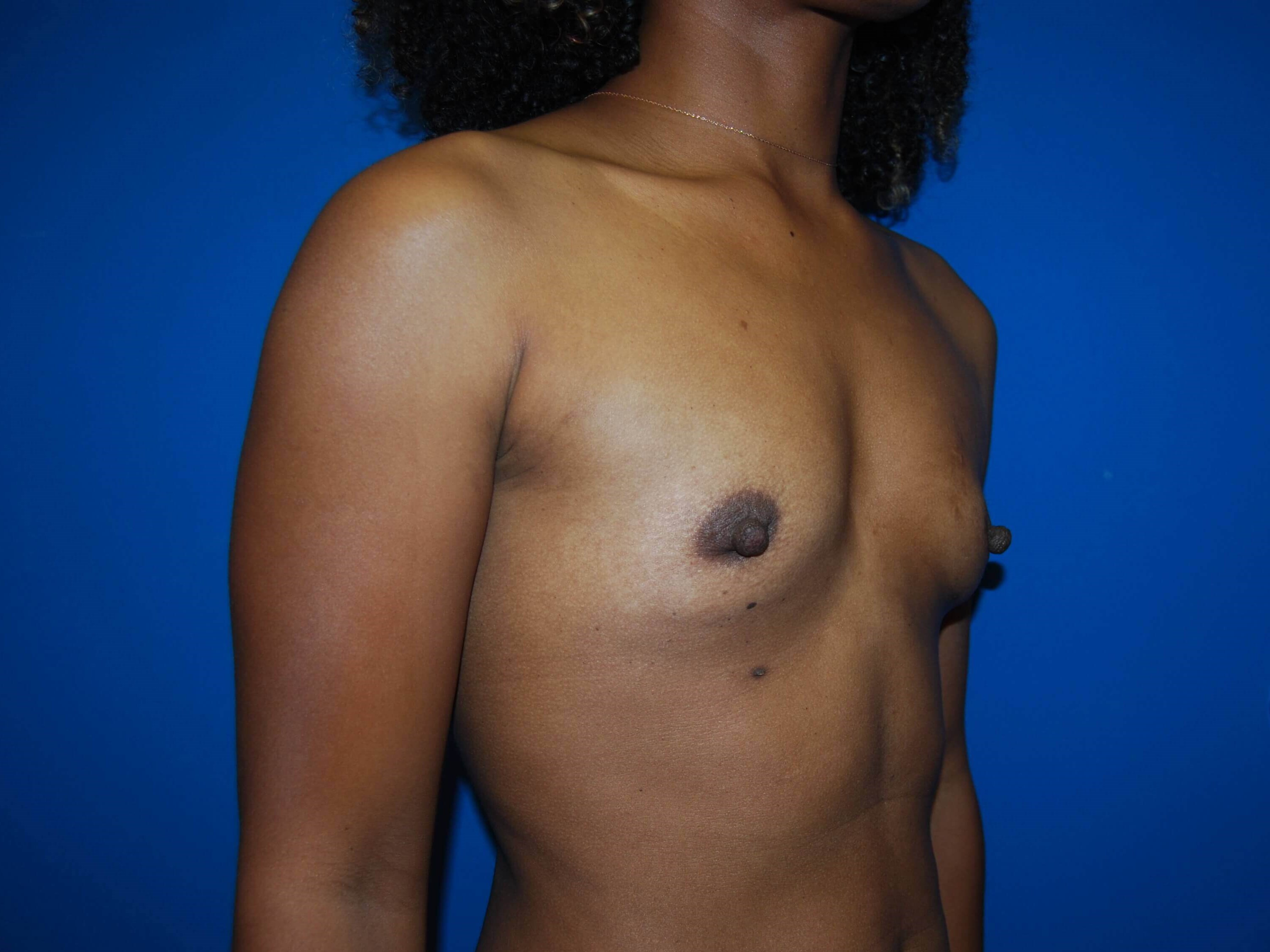 Right Before Implants