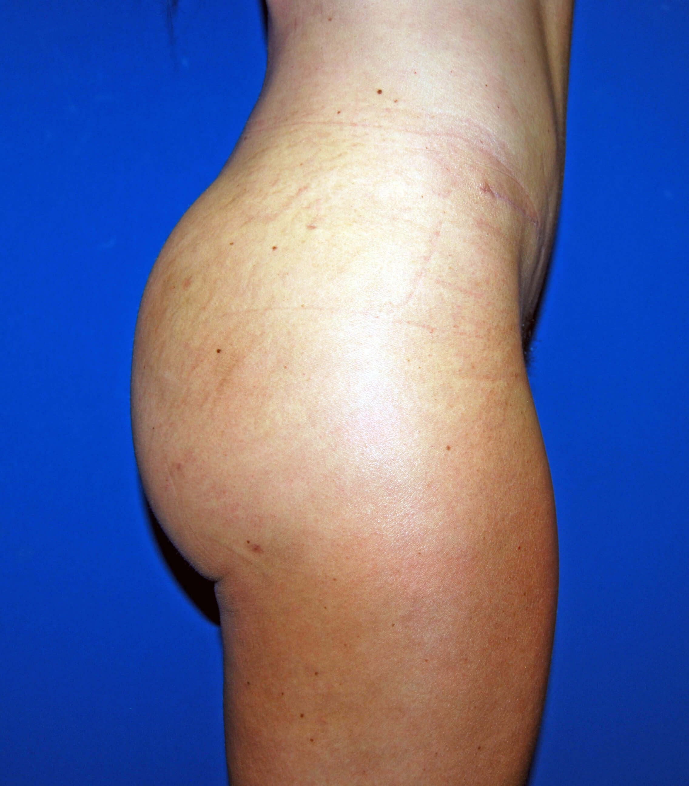Lateral After BBL